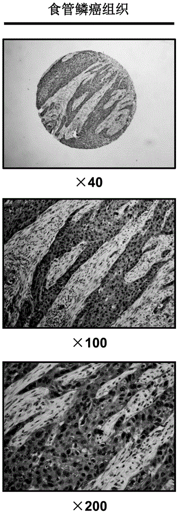 Use of the assembly inhibitor protein pfn2 in the preparation of diagnostic reagents for esophageal cancer