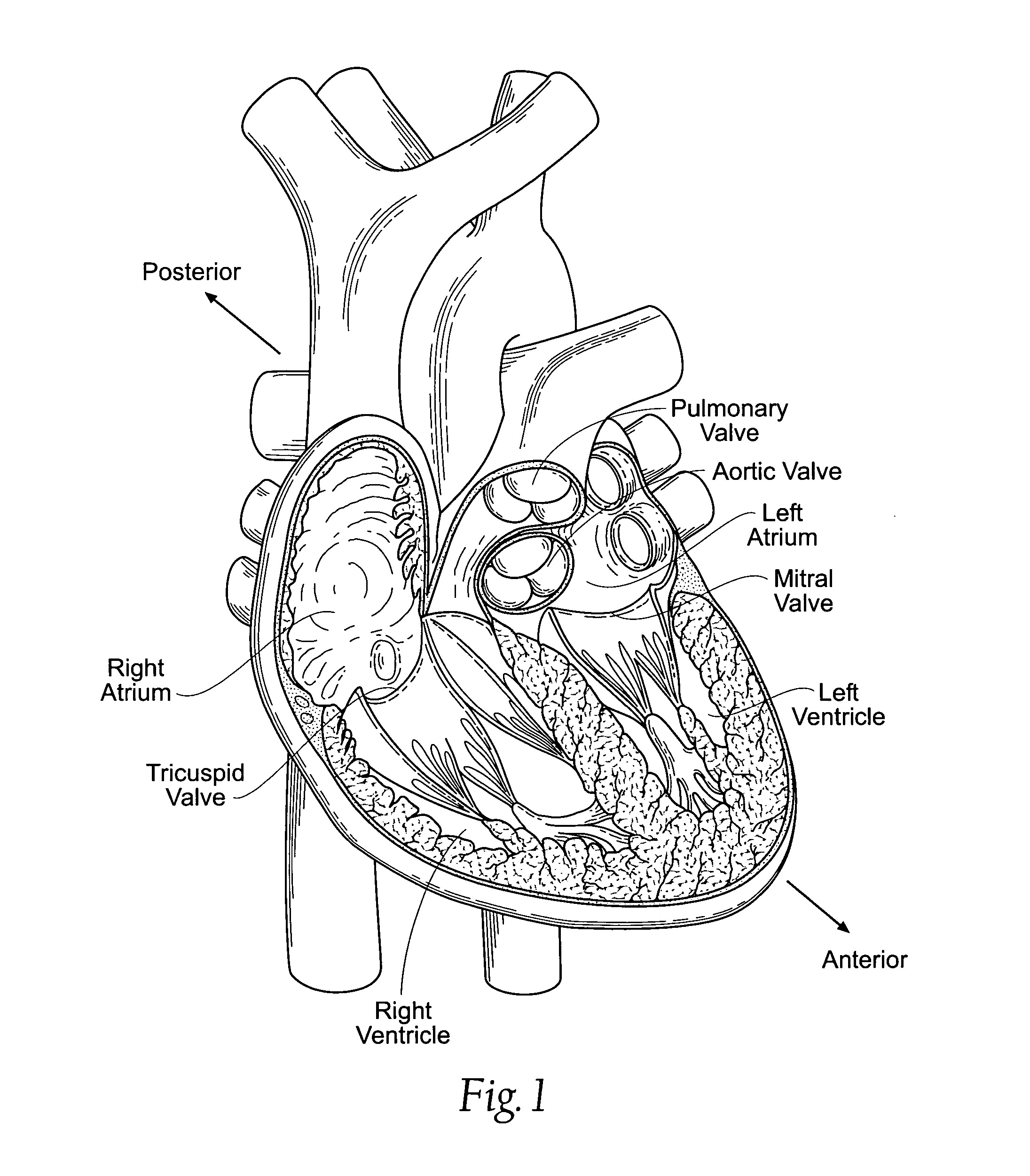 Devices, systems, and methods for supplementing, repairing, or replacing a native heart valve leaflet