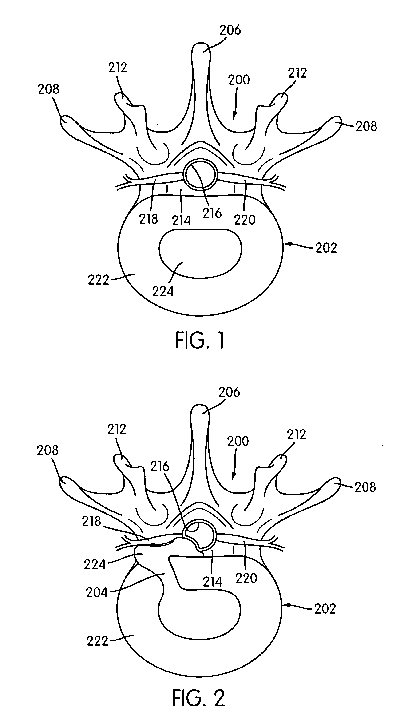 Disc annulus repair system