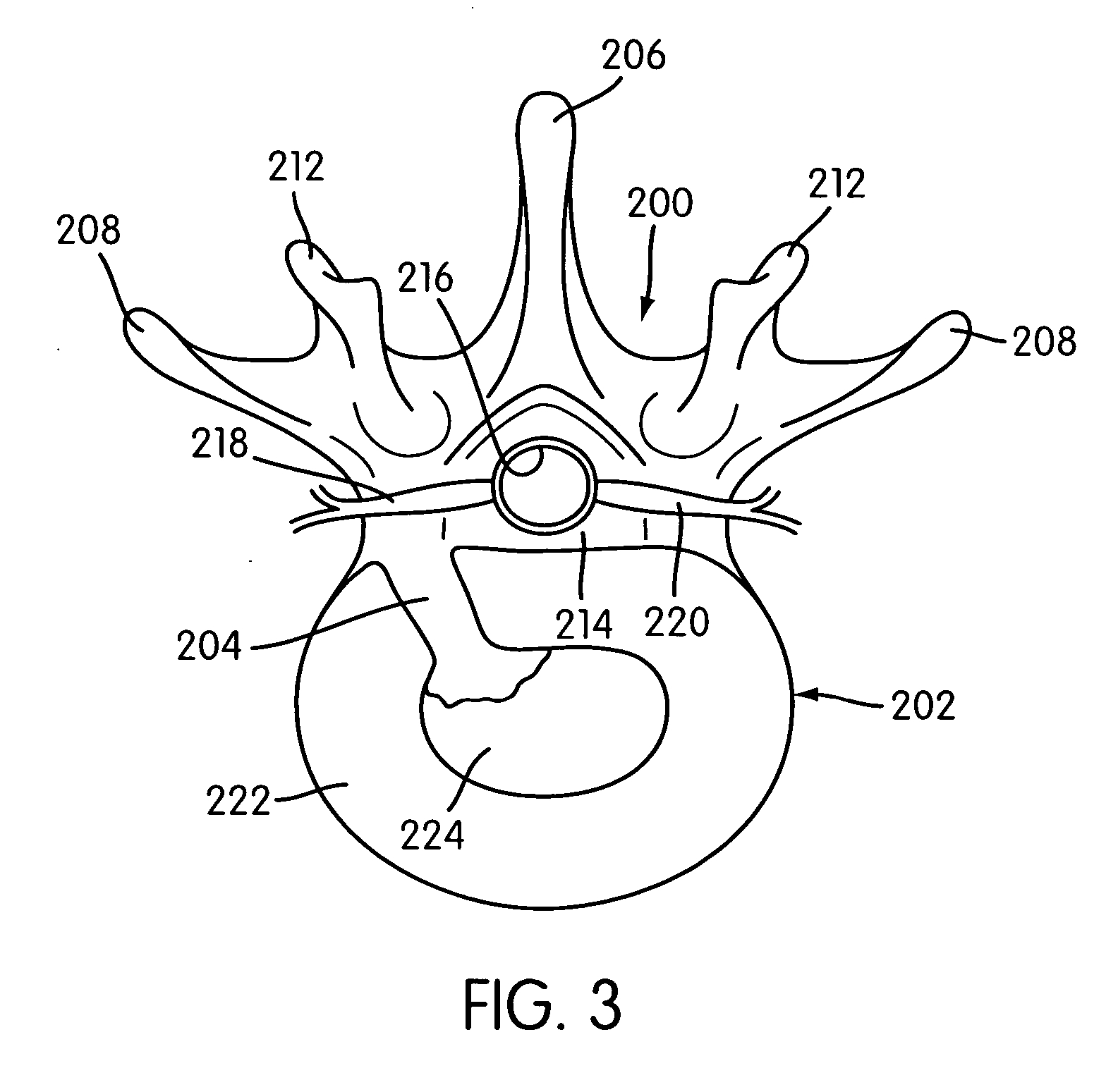 Disc annulus repair system