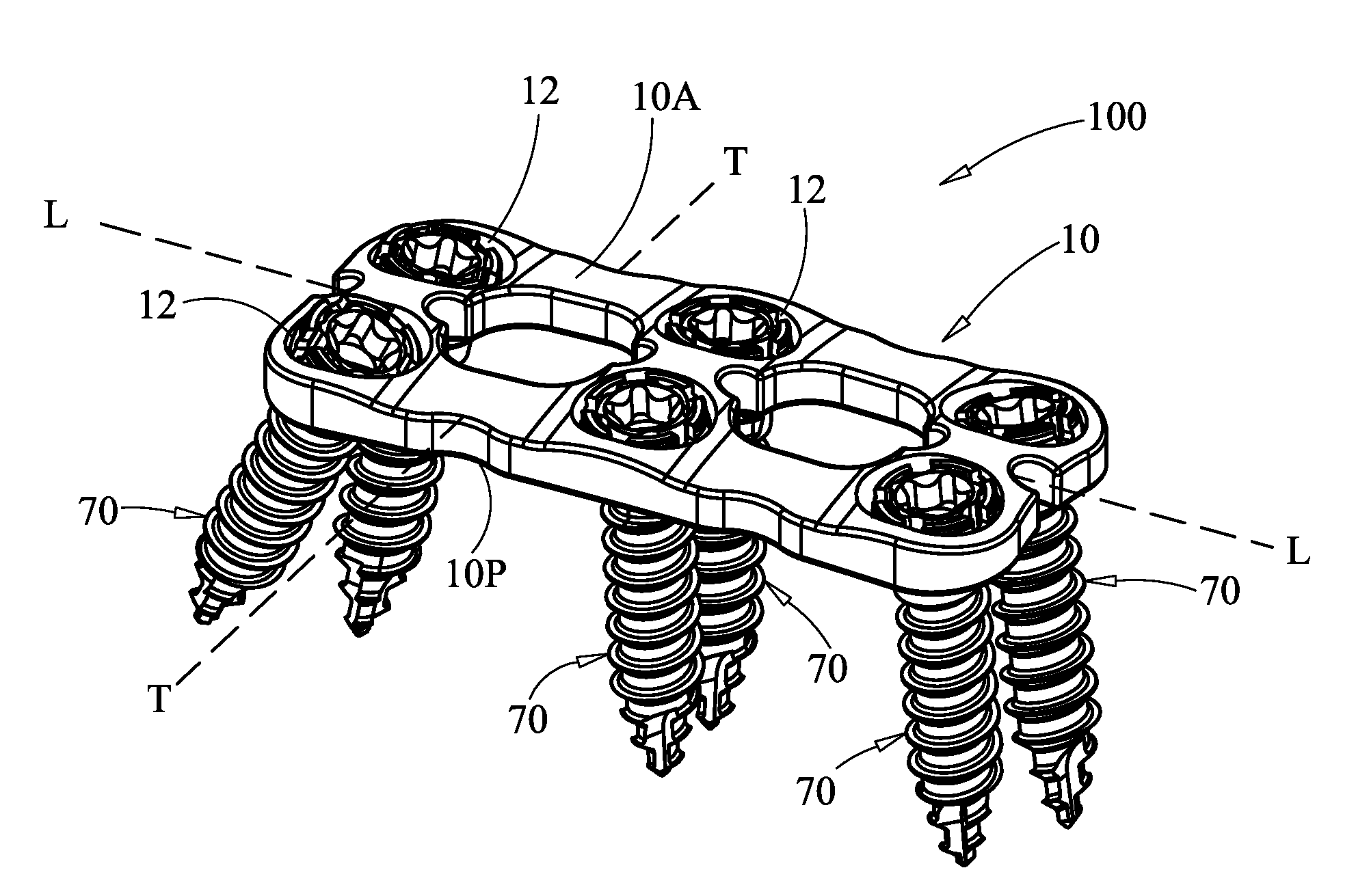Surgical plate system and method