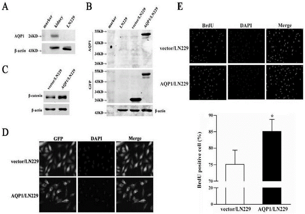 Relationship of beta-catenin expression and neuroglioma patient prognosis