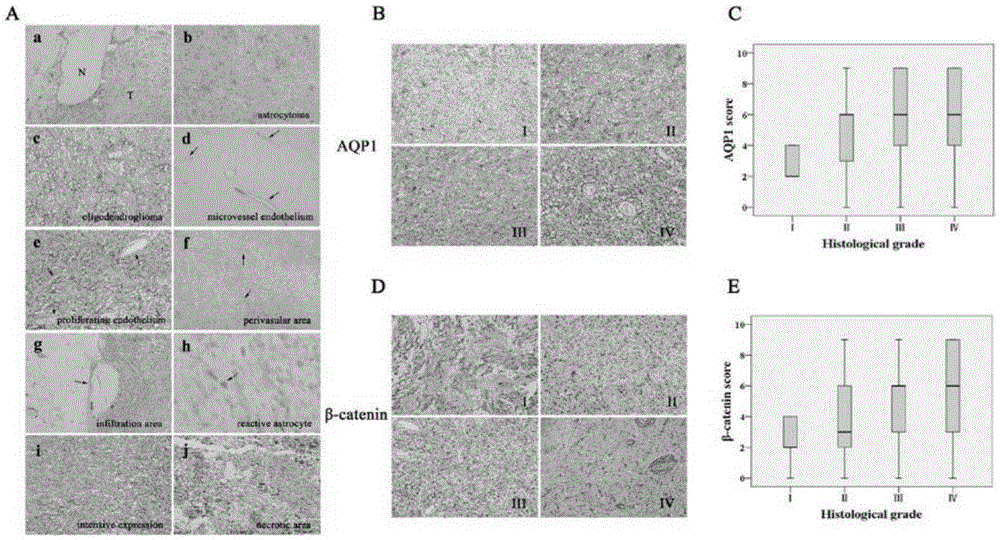 Relationship of beta-catenin expression and neuroglioma patient prognosis