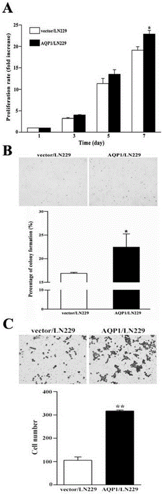 Relationship of beta-catenin expression and neuroglioma patient prognosis