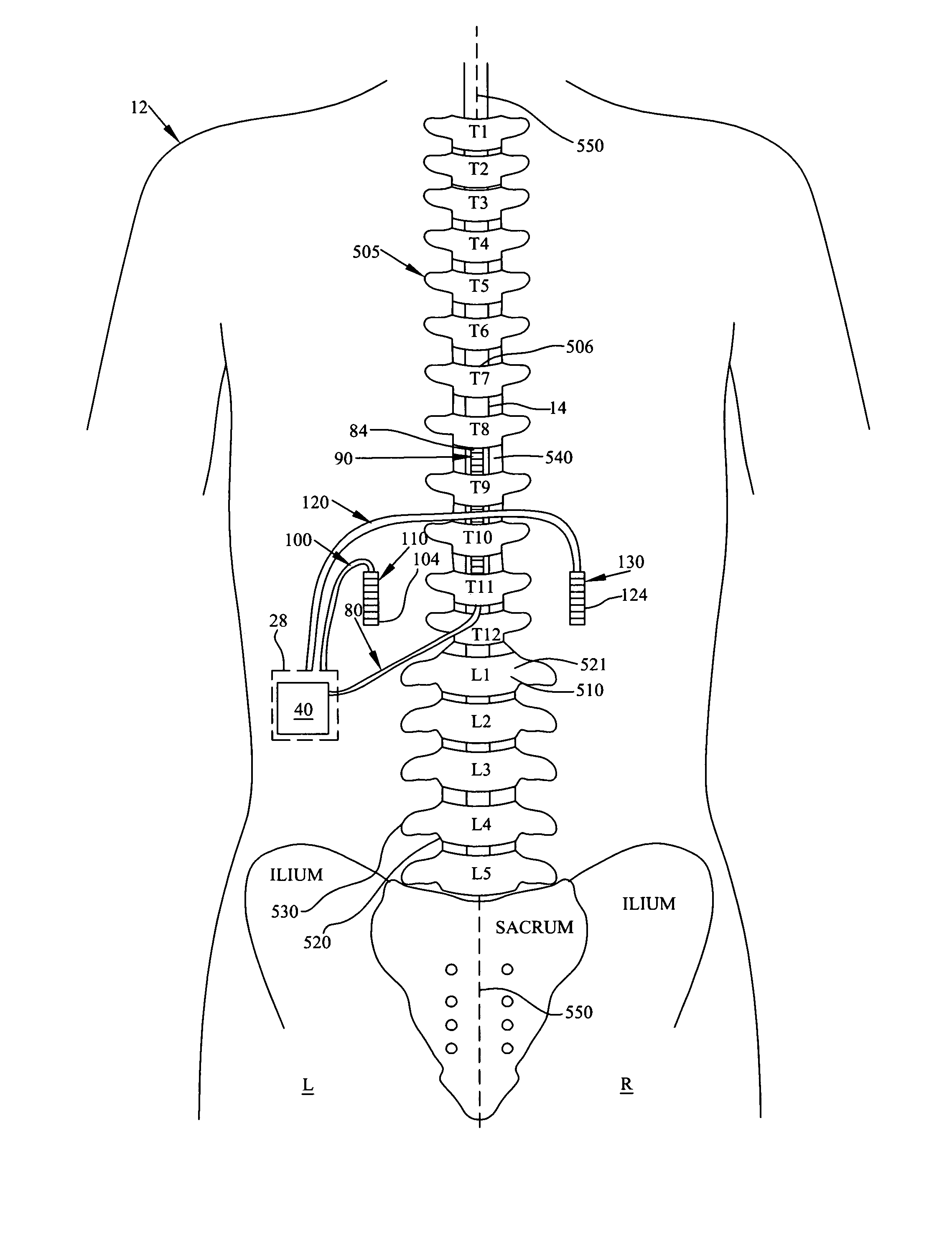 System and method for treating pain with peripheral and spinal neuromodulation