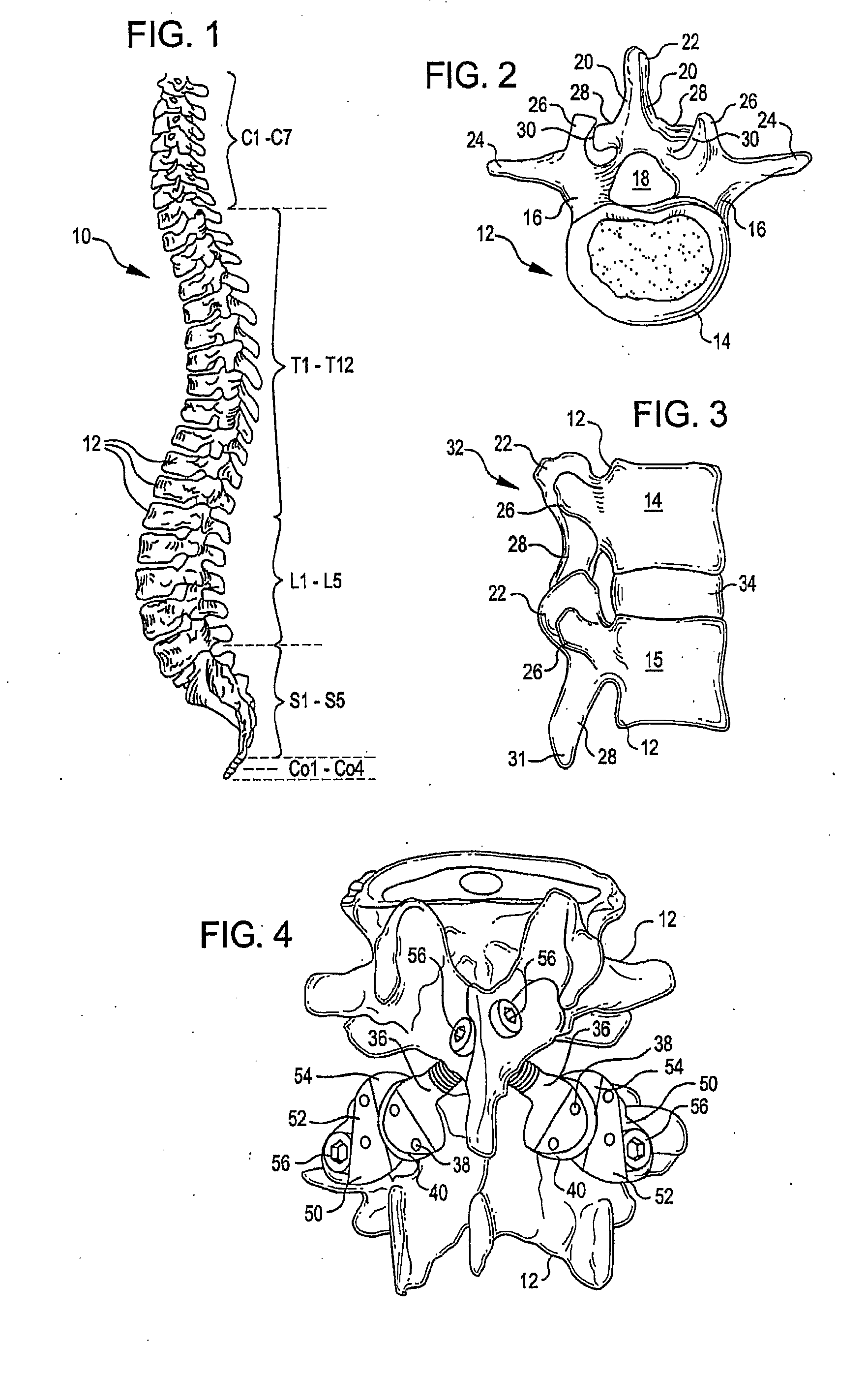 Crossbar Spinal Prosthesis Having a Modular Design and Systems for Treating Spinal Pathologies