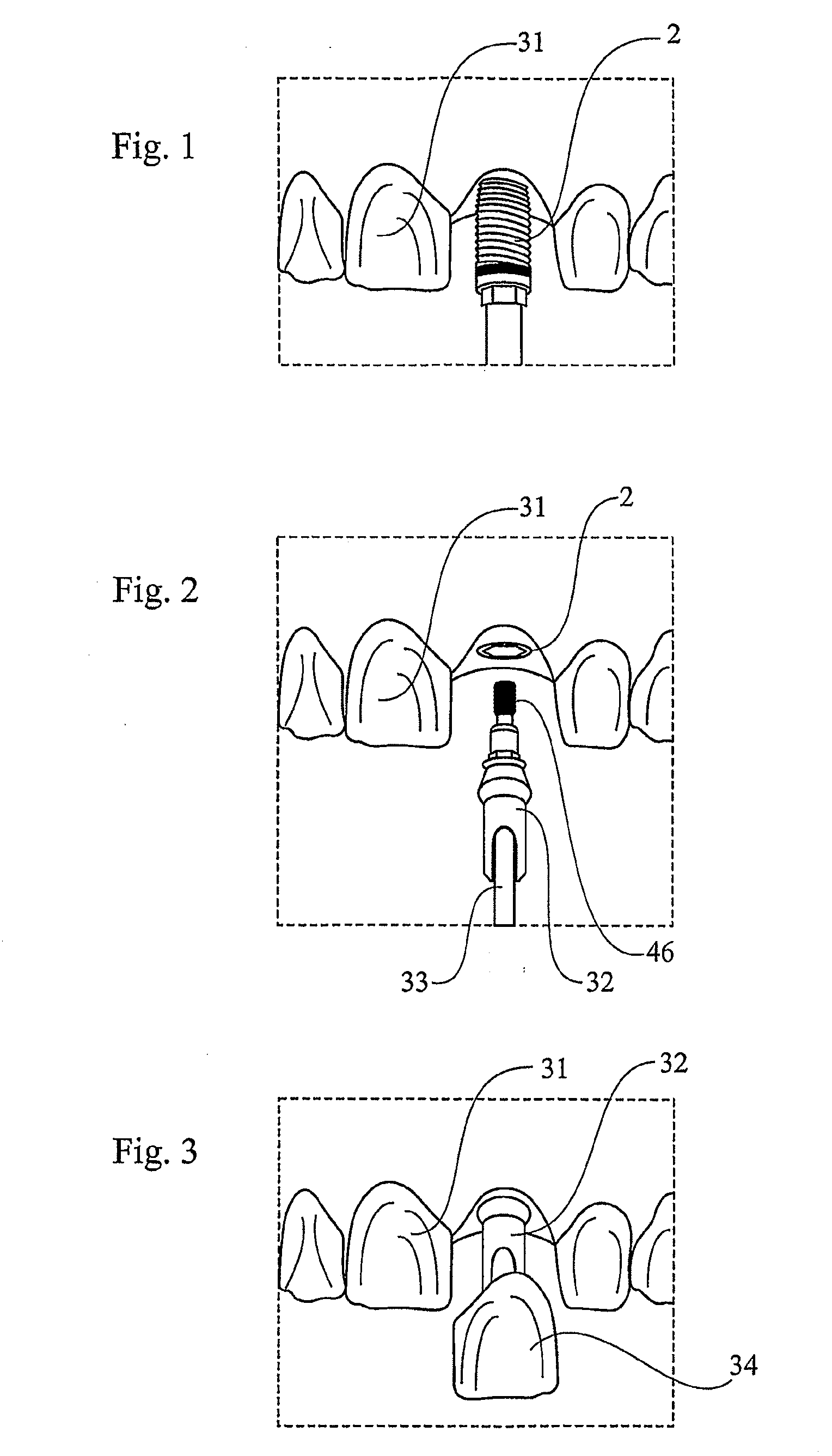 Device for securing a dental implant in bone tissue, a method for making a surgical template and a method of securing a dental implant in bone tissue