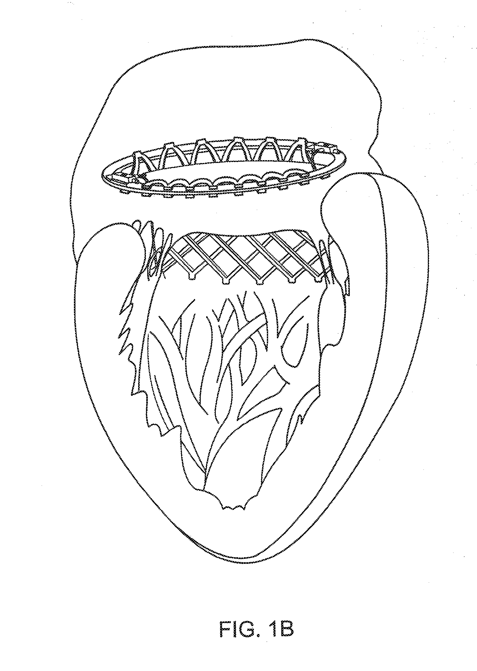 Stent With Mechanical Or Biological Heart Valve For Minimally Invasive Valve Replacement Procedure And Stent Application Device