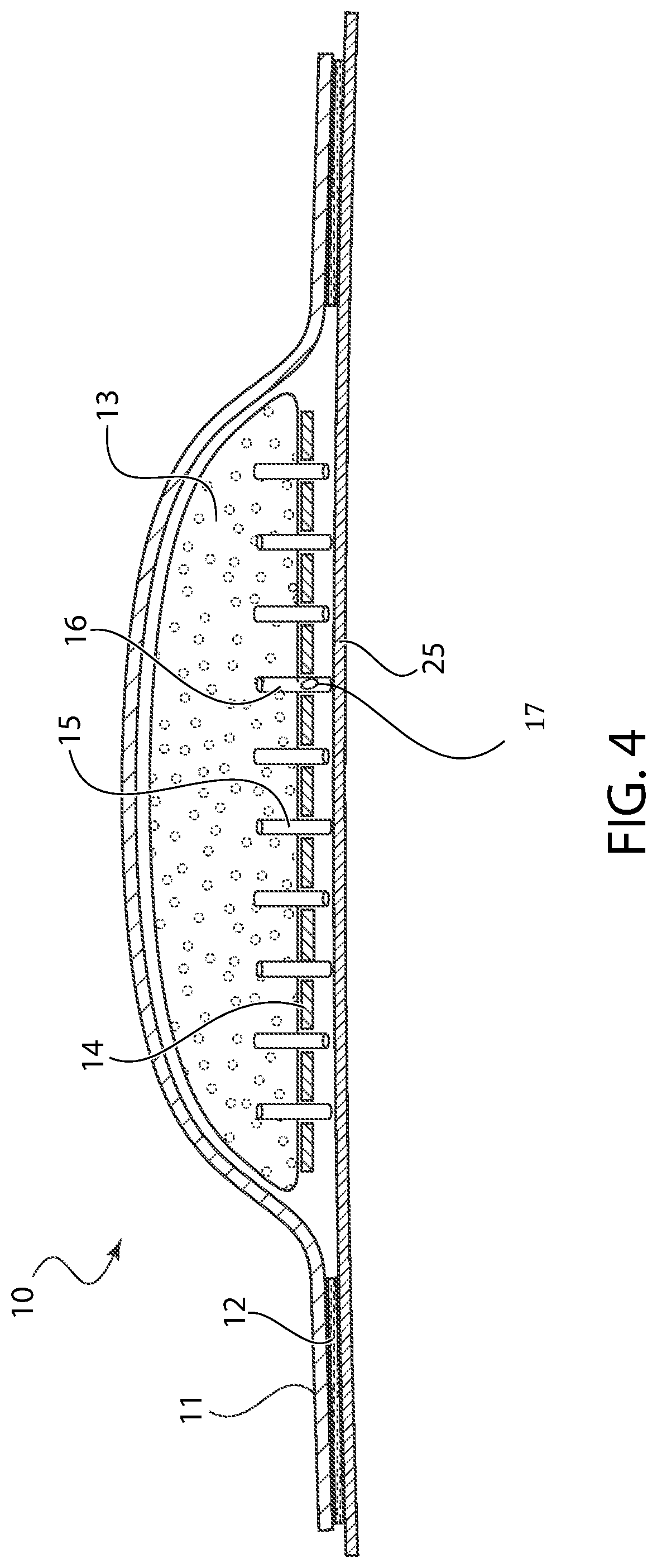 Bandage with microneedles for antimicrobial delivery and fluid absorption from a wound