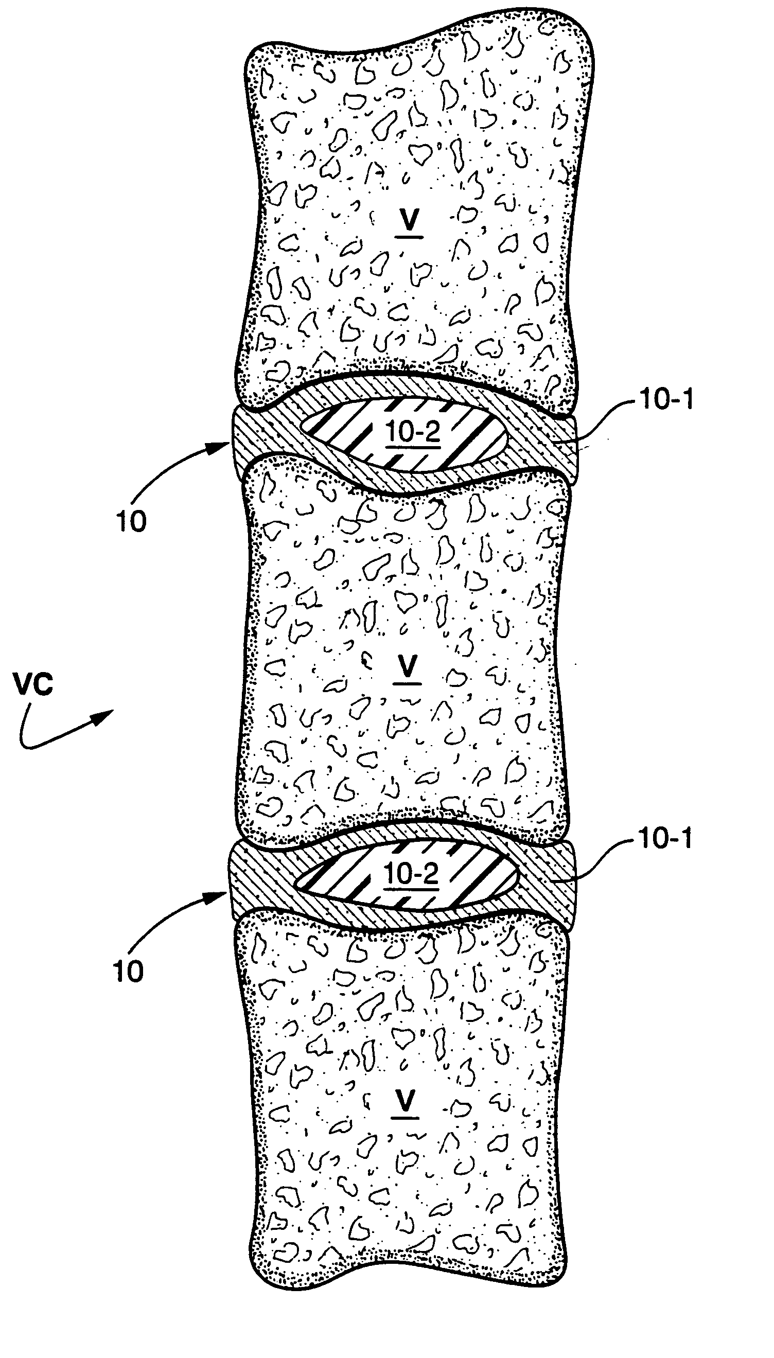 In situ bioprosthetic filler and methods, particularly for the in situ formation of vertebral disc bioprosthetics