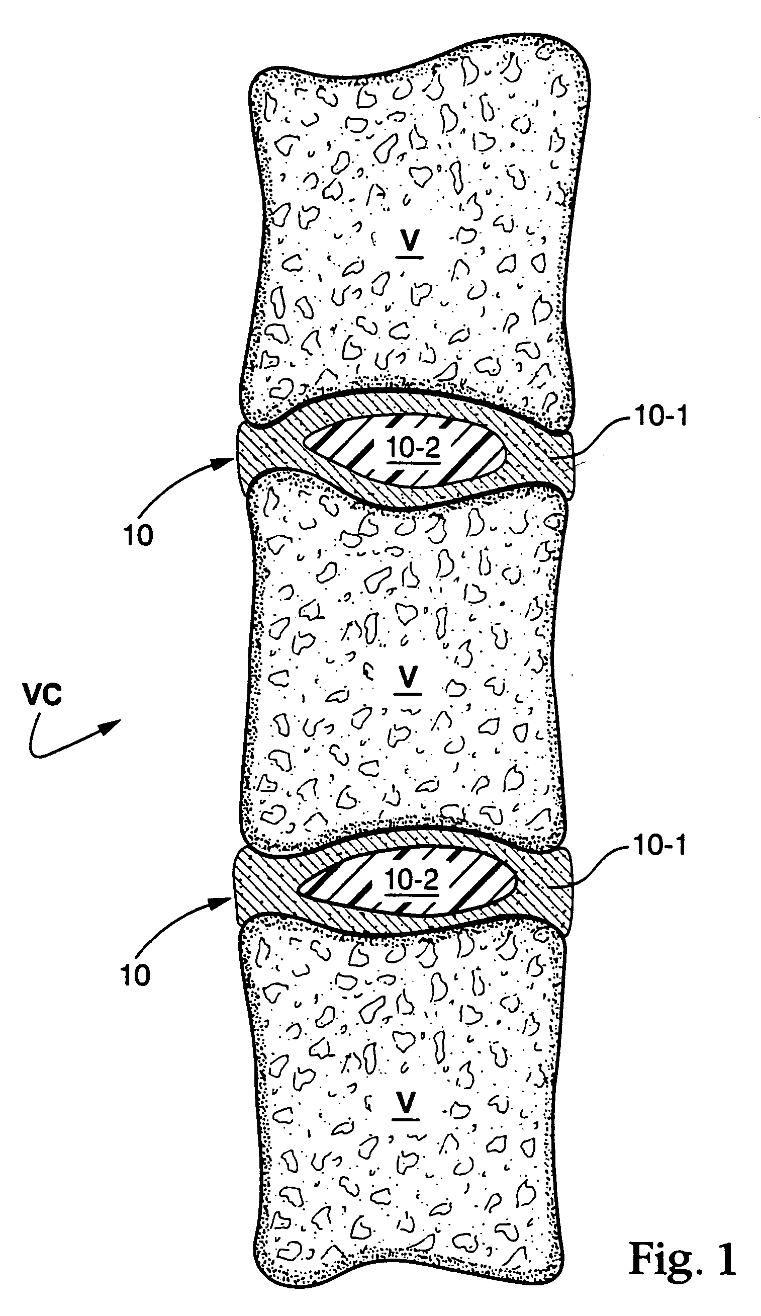 In situ bioprosthetic filler and methods, particularly for the in situ formation of vertebral disc bioprosthetics