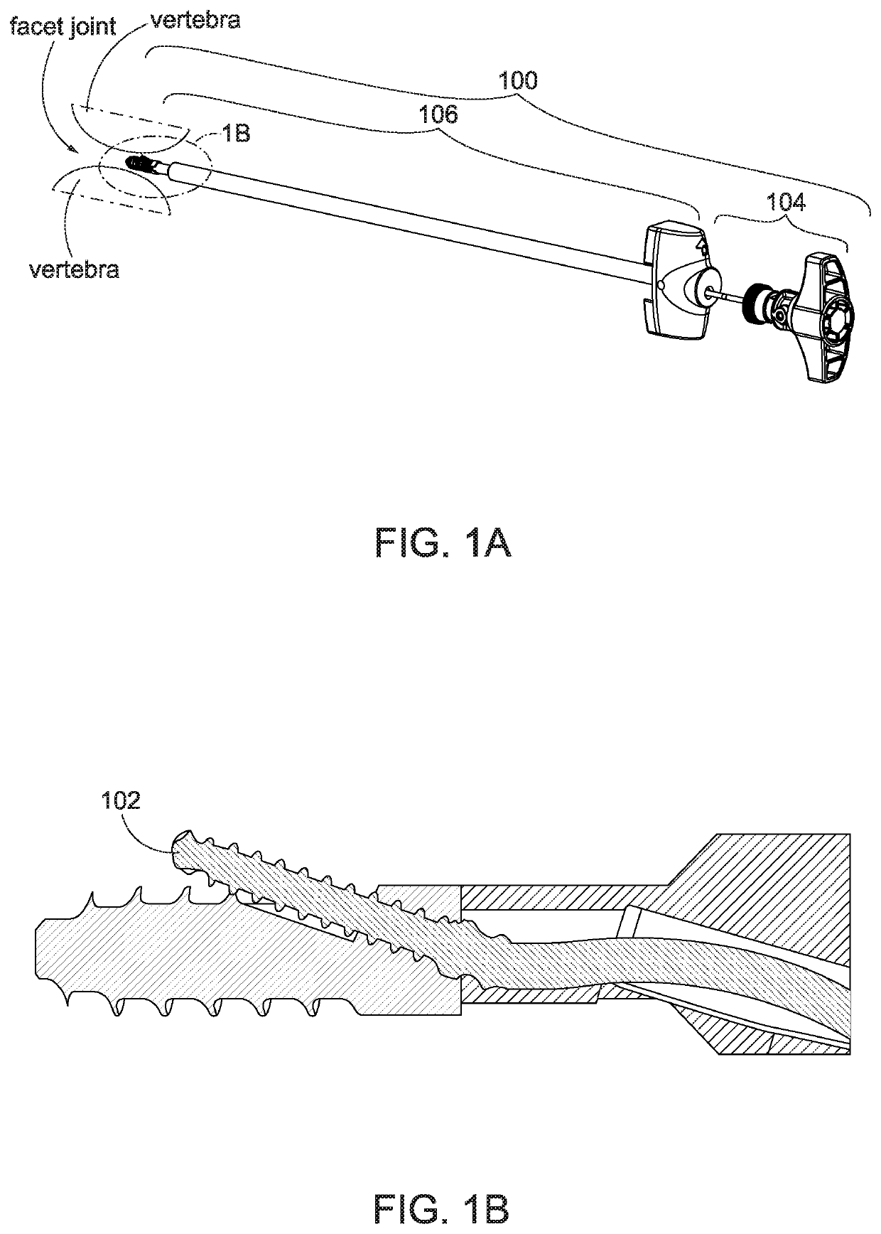 Facet screw and delivery device