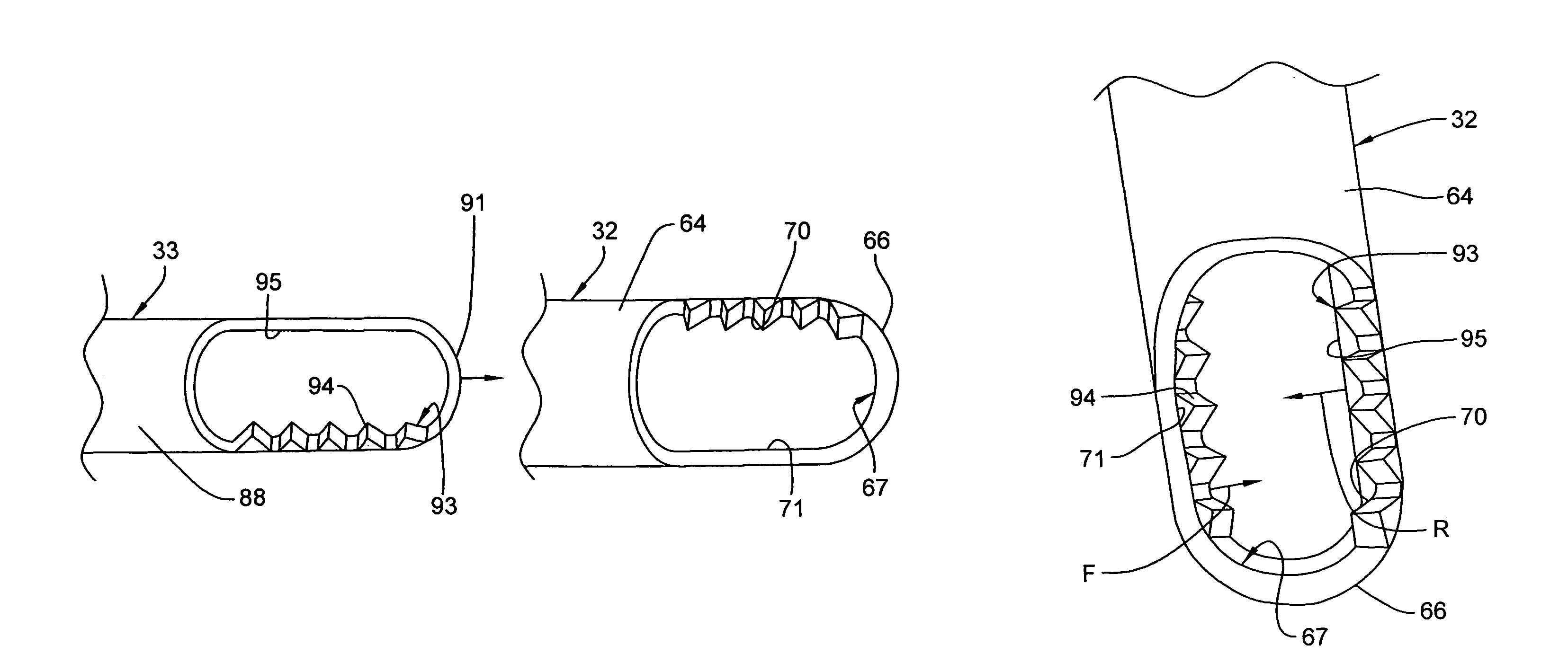 Surgical tool arrangement and surgical cutting accessory for use therewith with the tool arrangement including a toothed cutting edge and a generally straight cutting edge