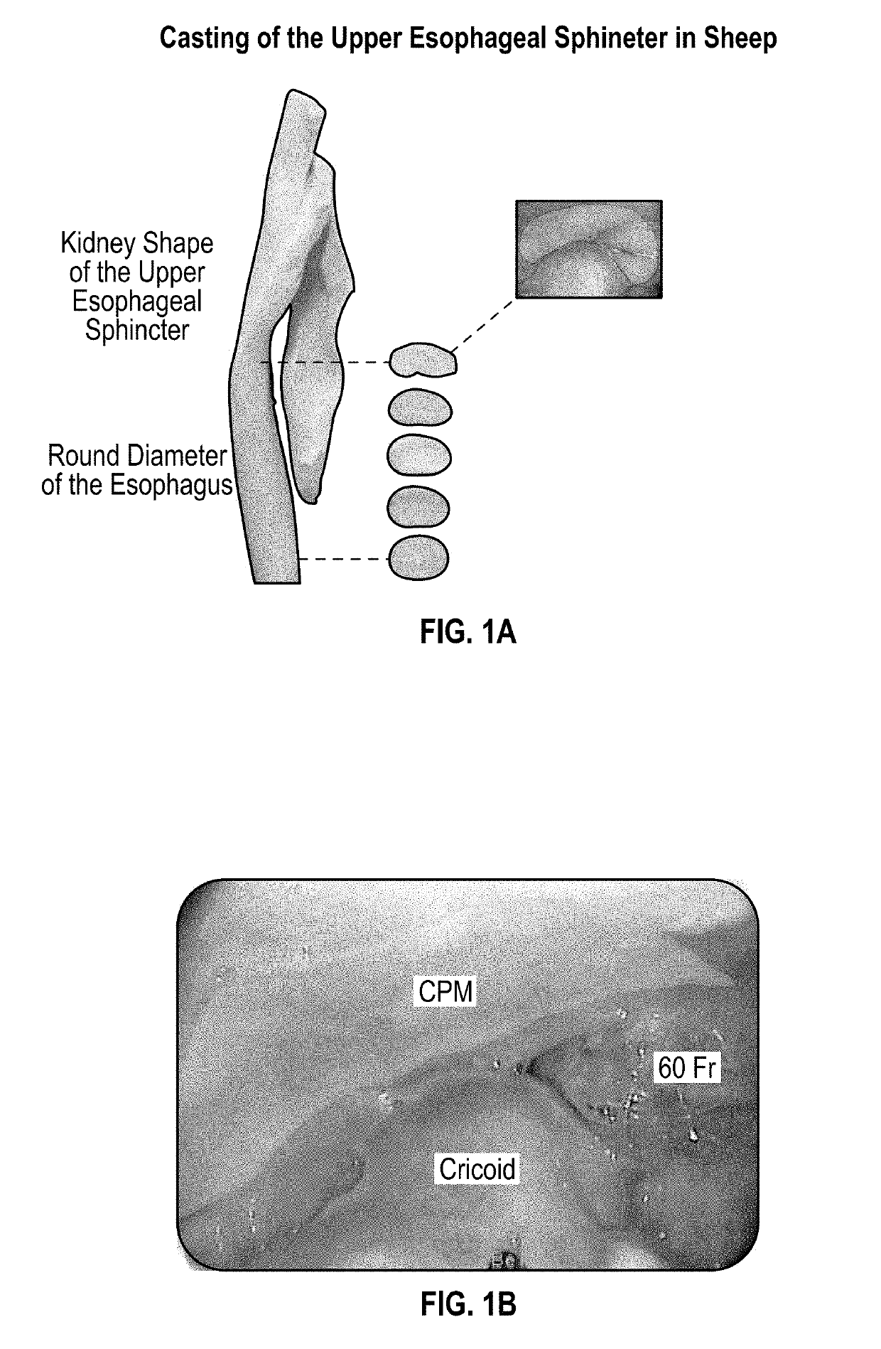 Upper esophageal sphincter dilator