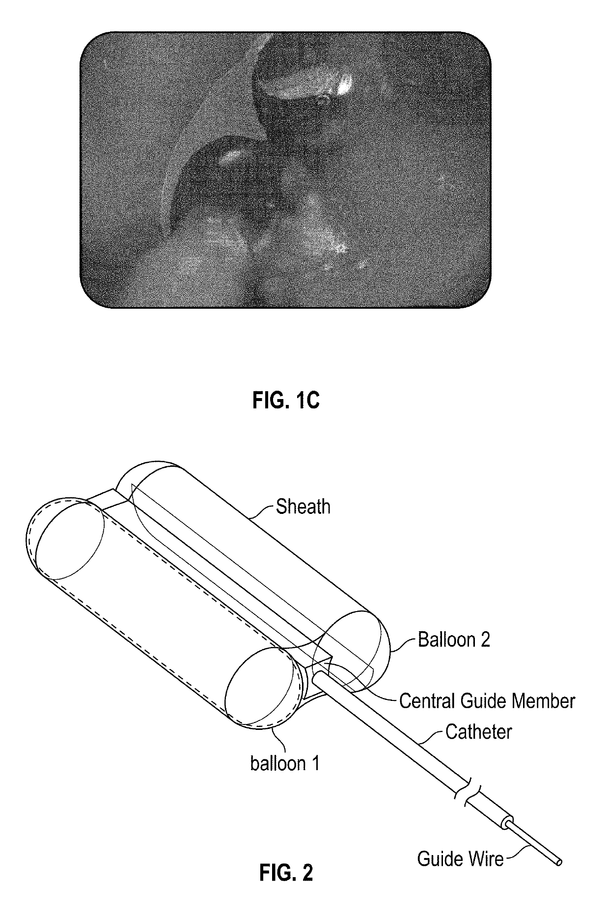 Upper esophageal sphincter dilator