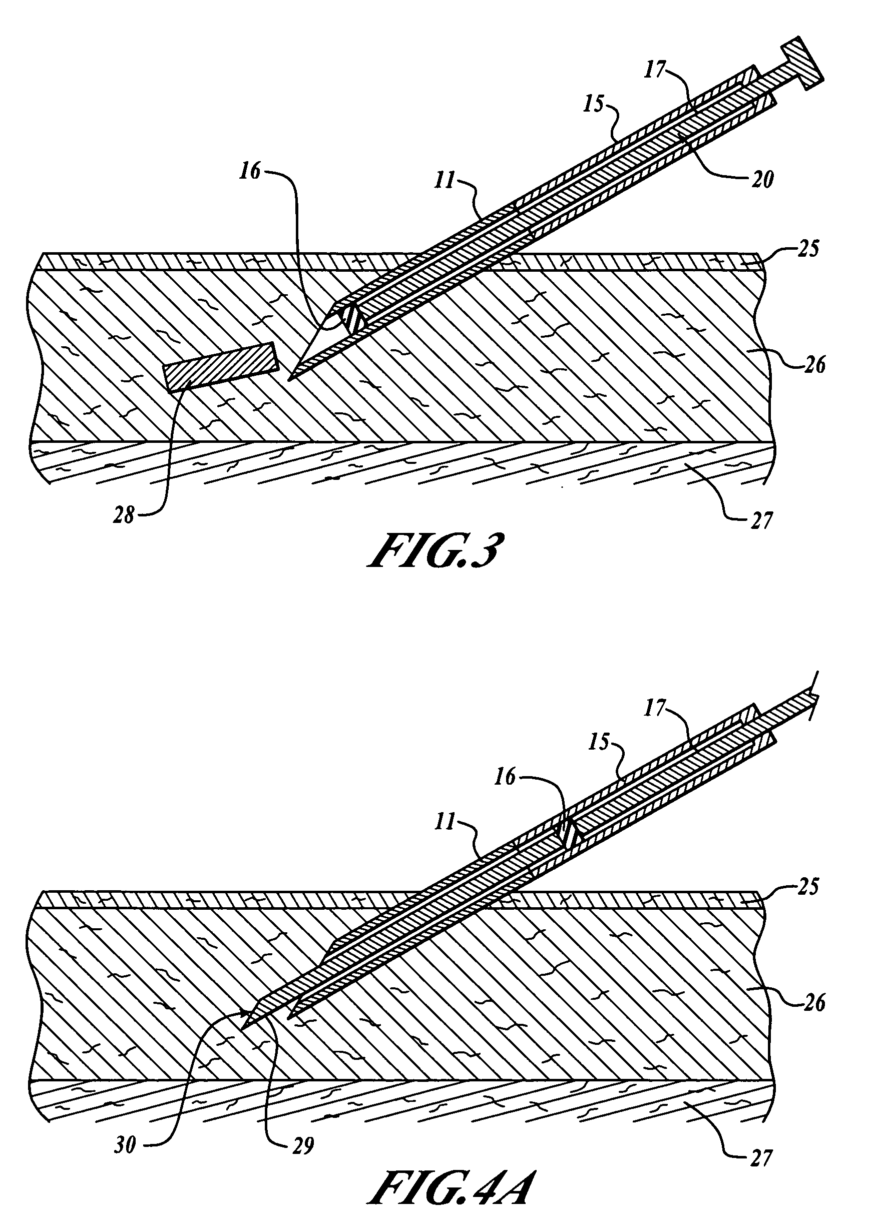 Subcutaneous implantation instrument with dissecting tool and method of construction