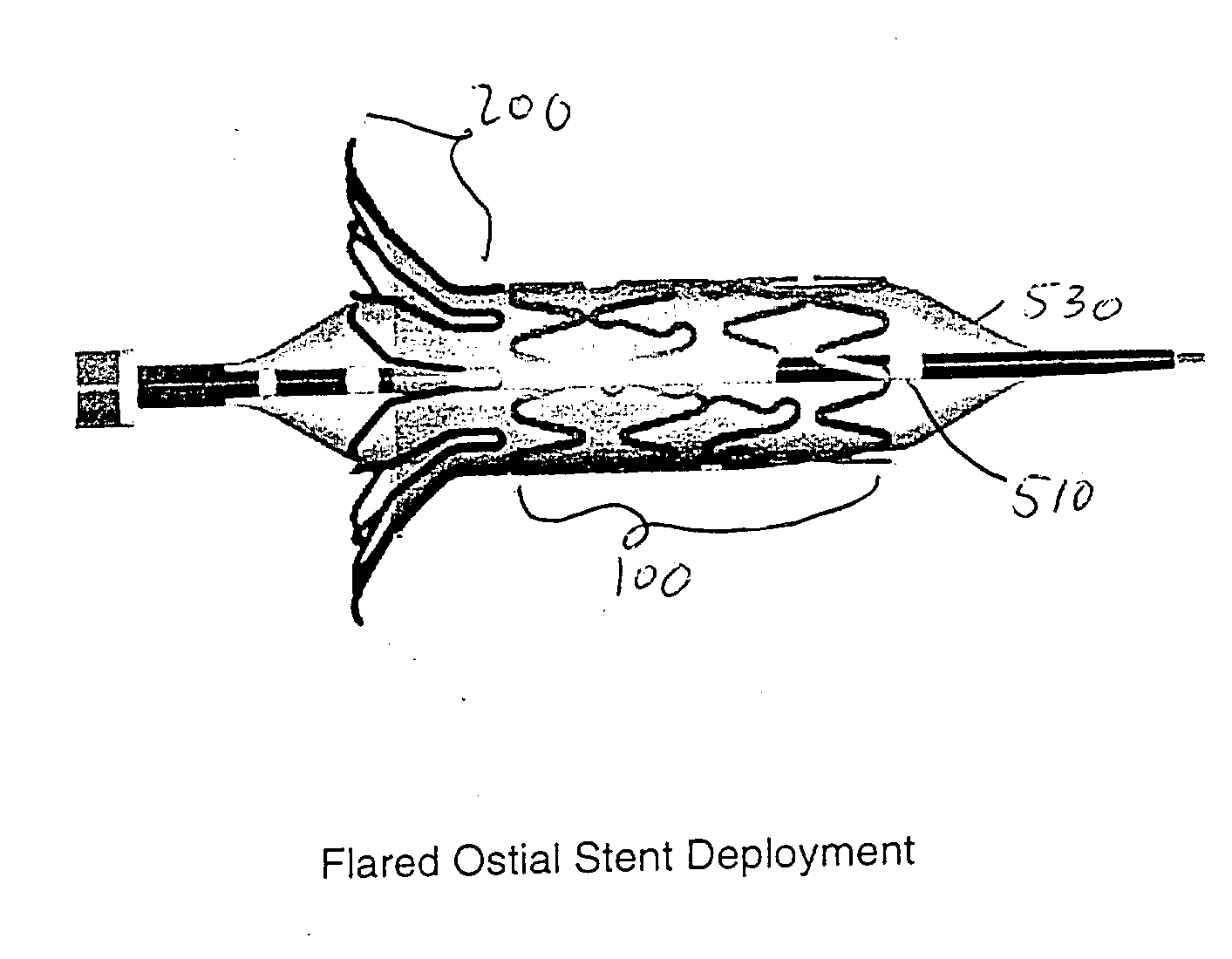 Flared ostial endoprosthesis and delivery system