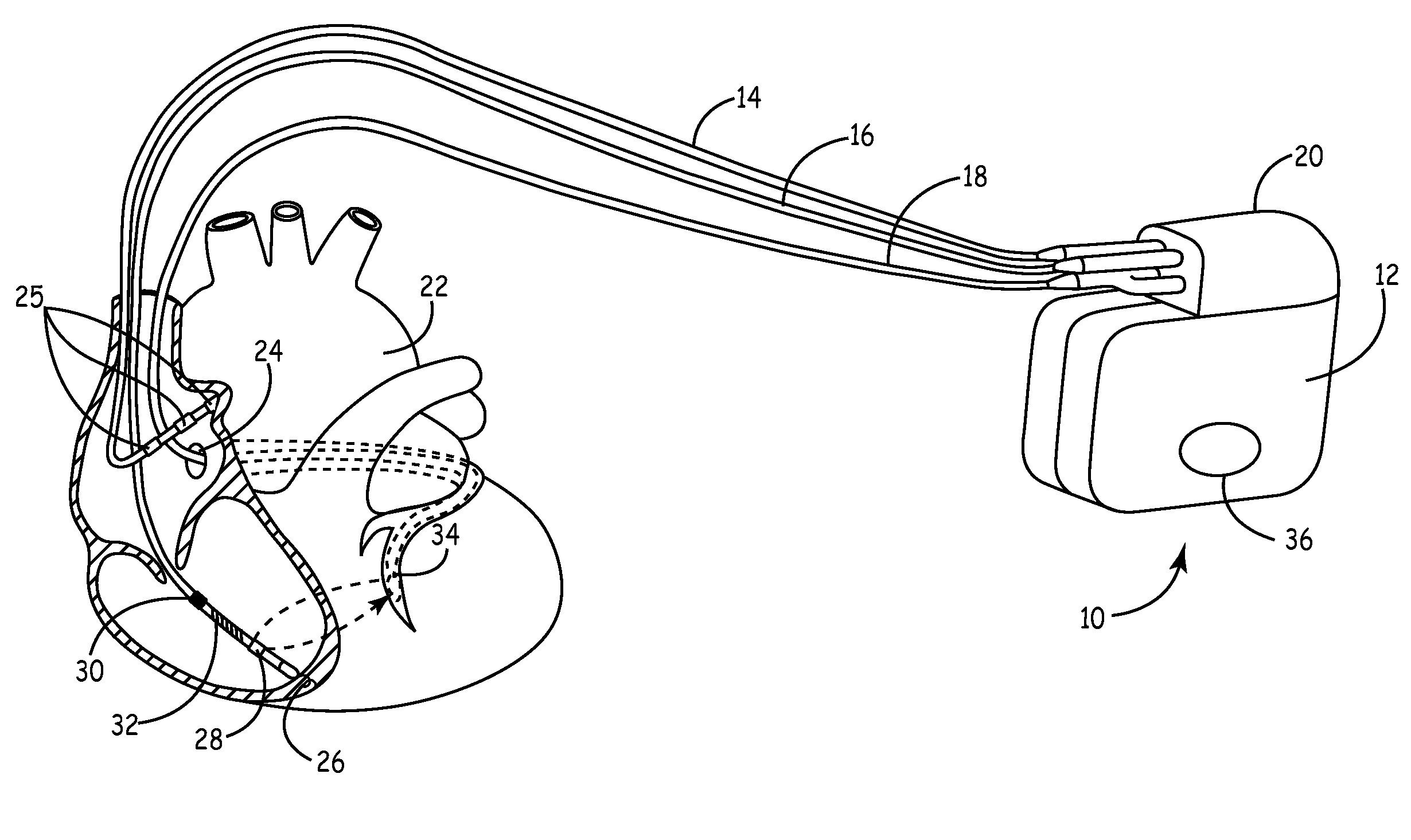 Pressure and Impedance Based Discrimination of Hemodynamic Stability