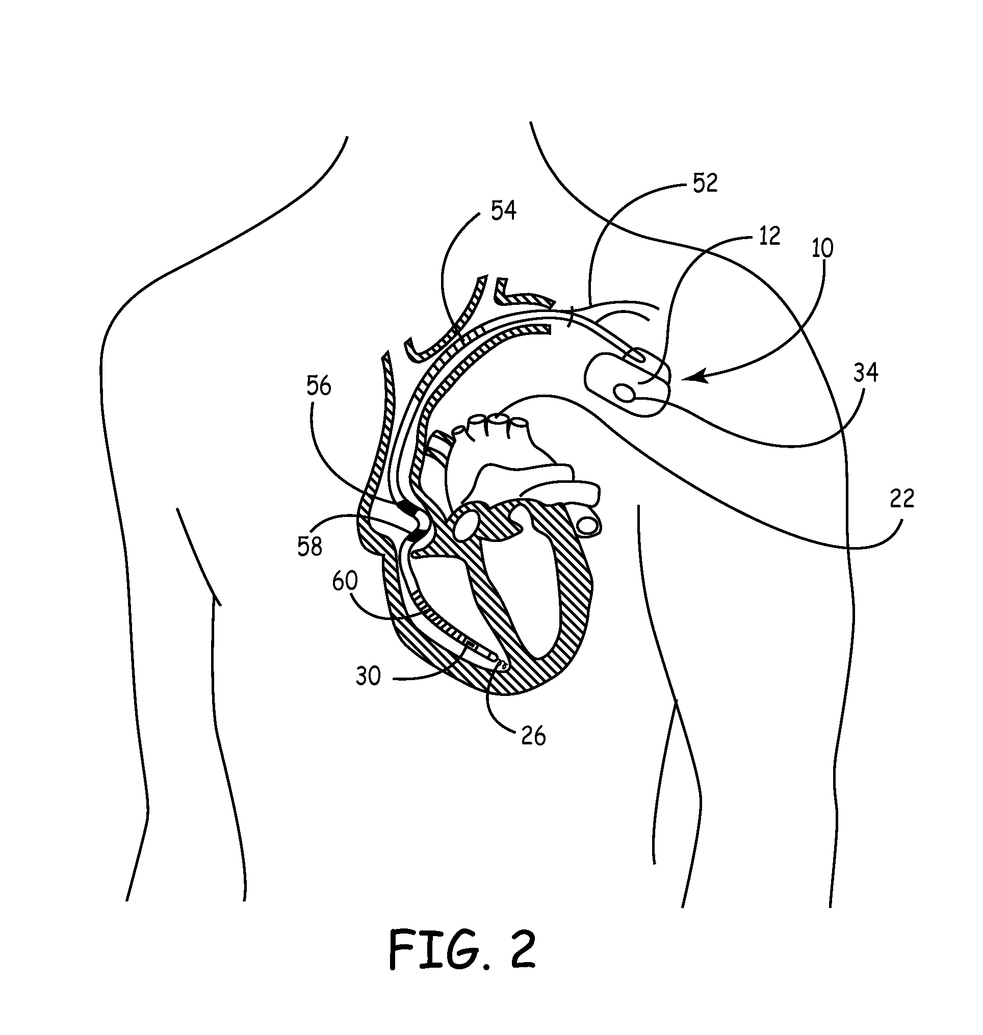 Pressure and Impedance Based Discrimination of Hemodynamic Stability