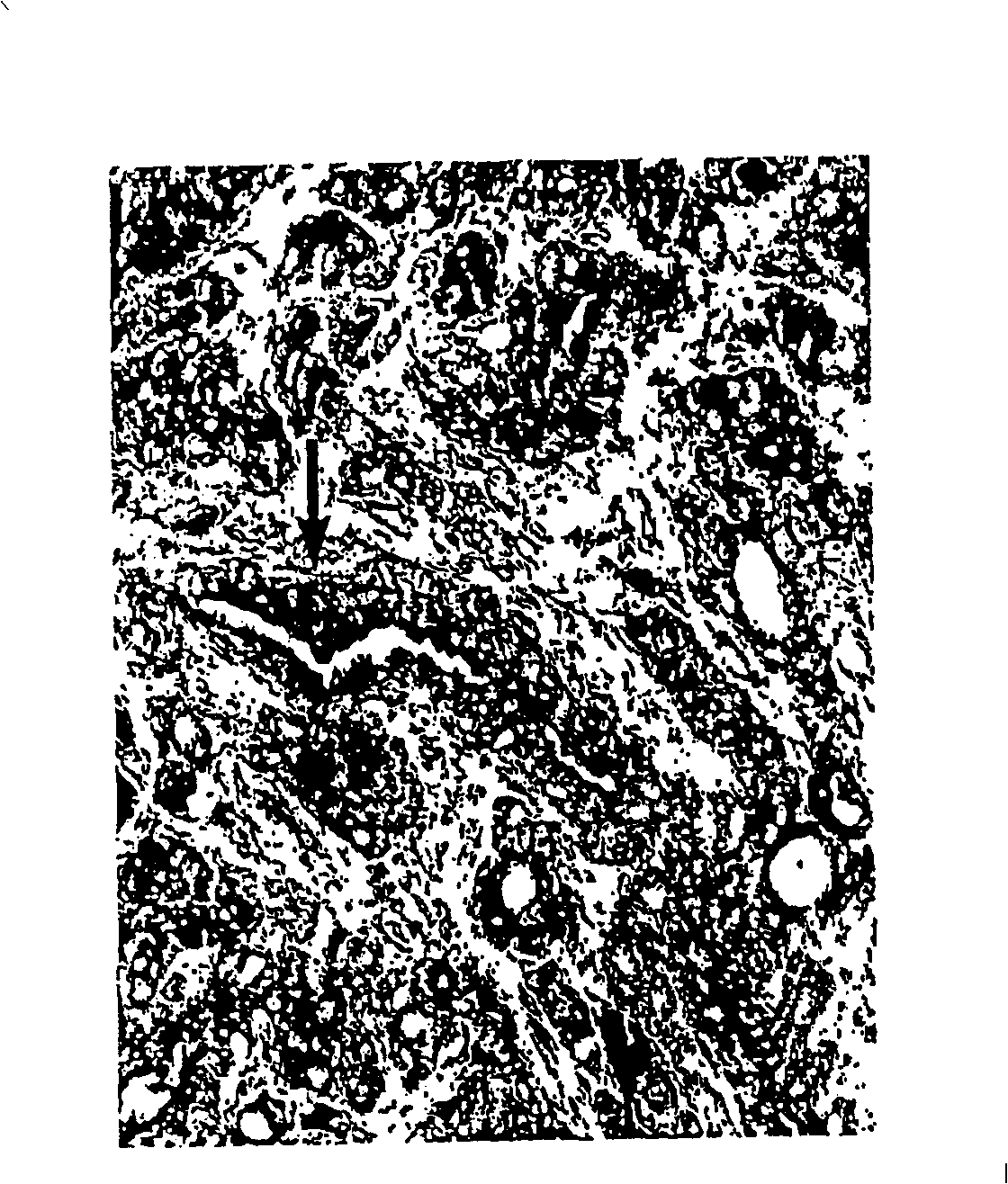 Use of P2Y purinergic receptor expression for identifying preneoplastic and neoplastic states