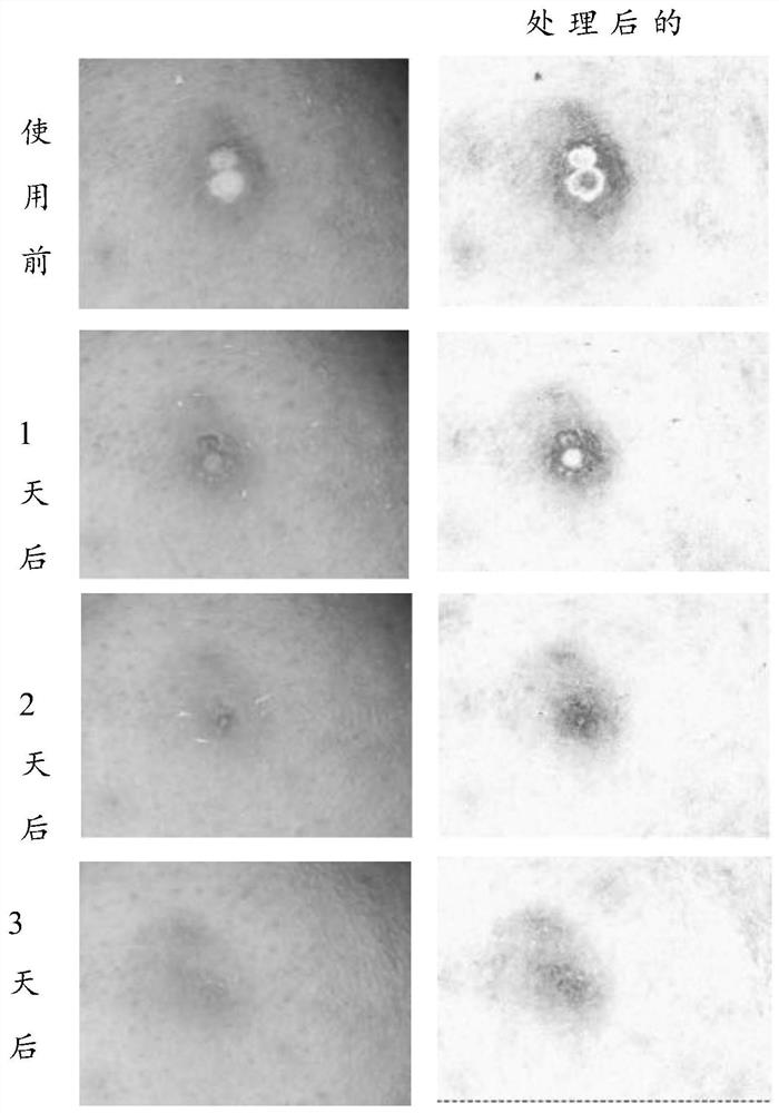 Composition for removing acnes and repairing skin barrier, and preparation method and application of composition