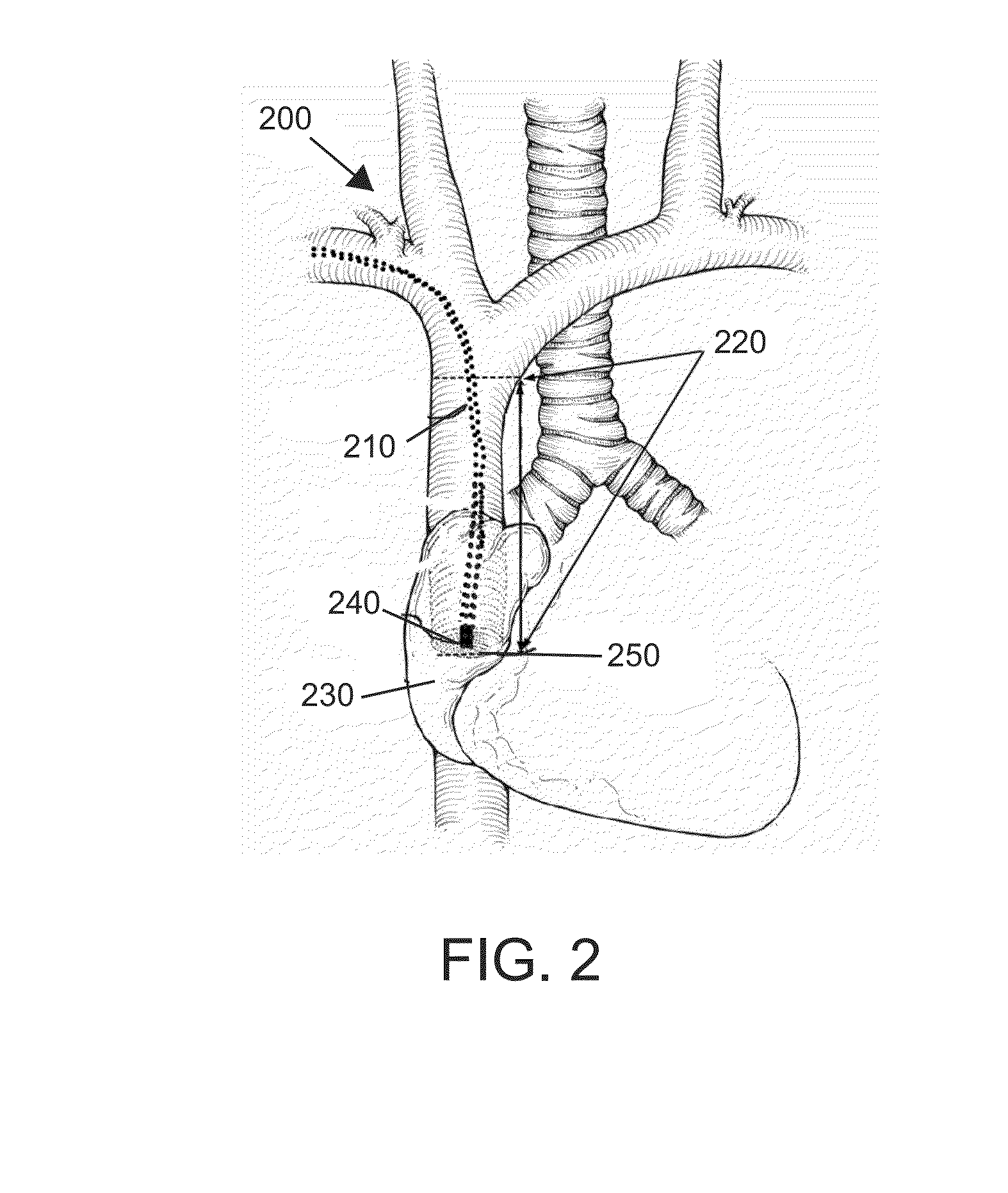 Method and System of Utilizing ECG Signal for Central Venous Catheter Tip Positioning