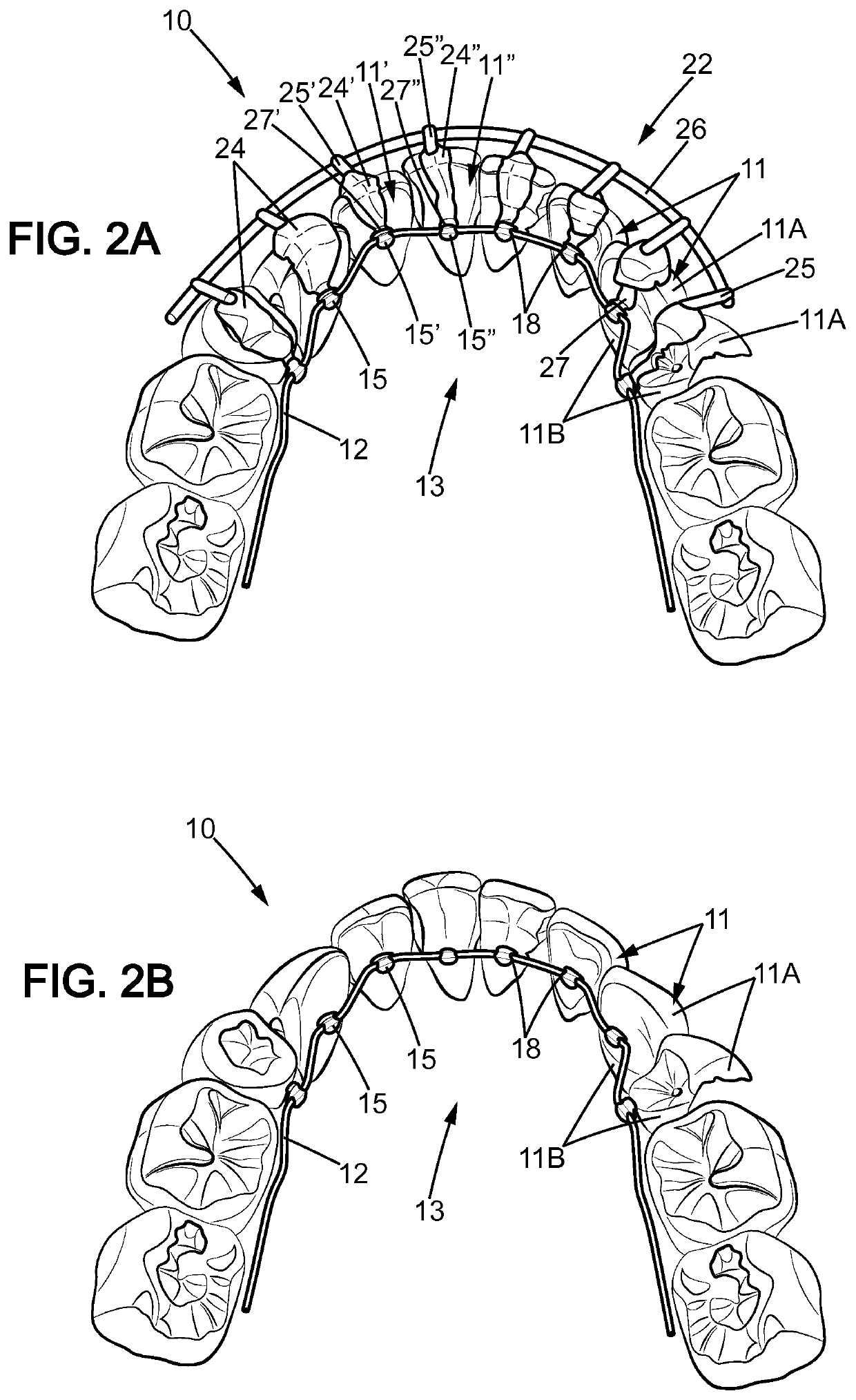 An orthodontic system for the orthodontic treatment of a patient's teeth, a method for the placement of an appliance for the orthodontic treatment of a patient's teeth, and a use of the appliance of such an orthodontic system