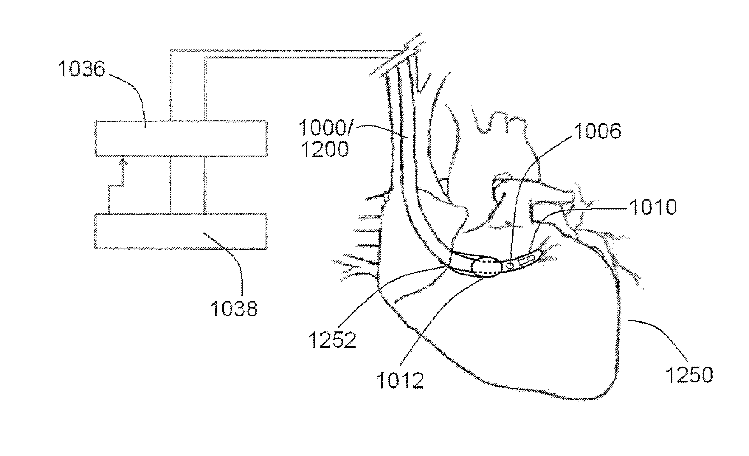 Impedance devices and methods of using the same in connection with a mammalian vasculature