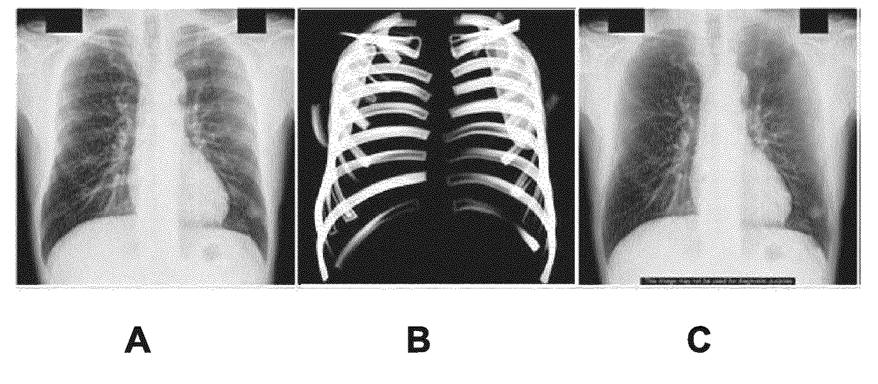 Silhouette display for visual assessment of calcified rib-cartilage joints