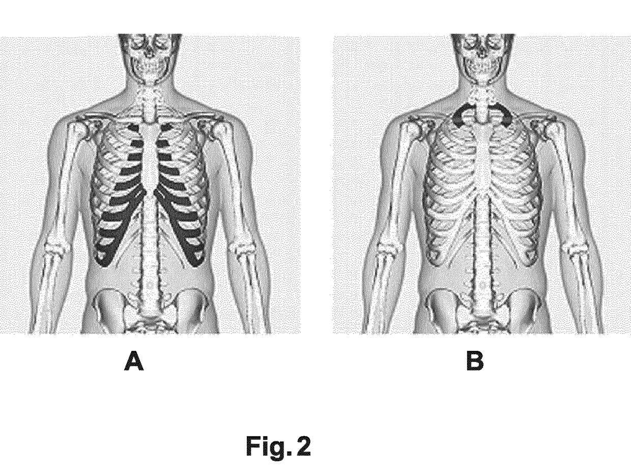 Silhouette display for visual assessment of calcified rib-cartilage joints