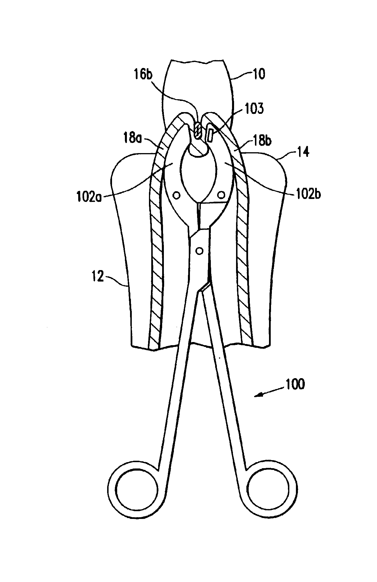 Methods for minimally-invasive, non-permanent occlusion of a uterine artery