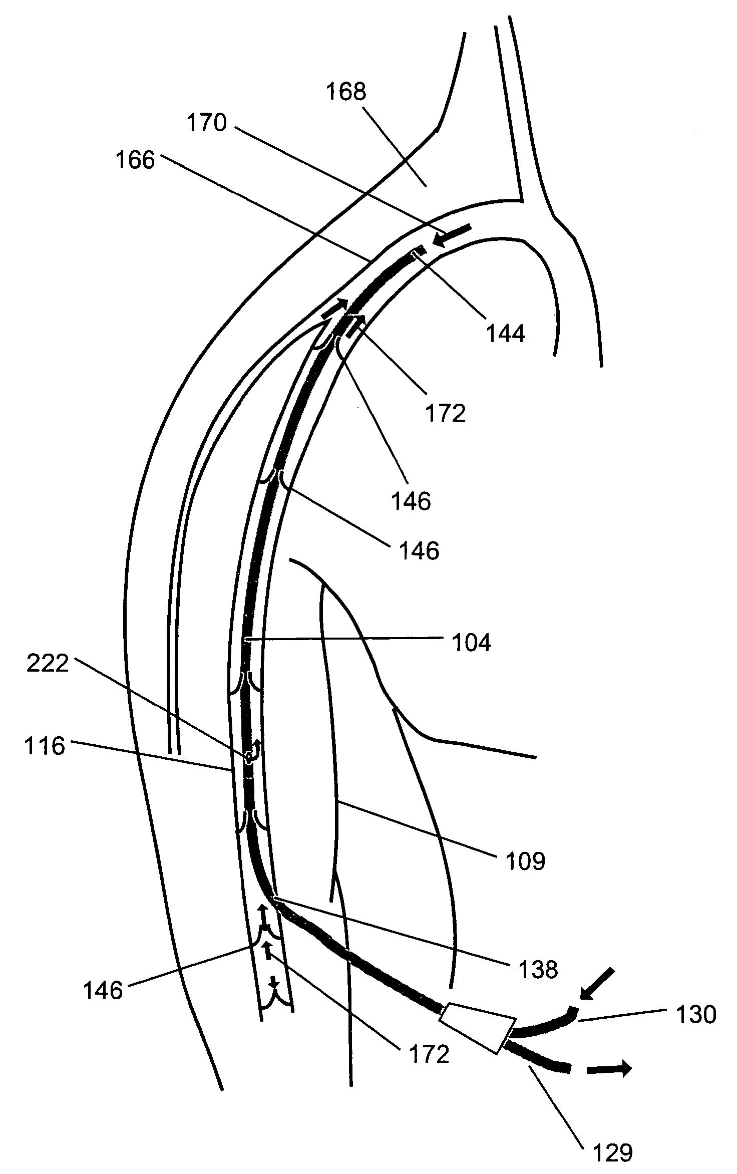 Method and apparatus for ultrafiltration utilizing a peripheral access dual lumen venous cannula