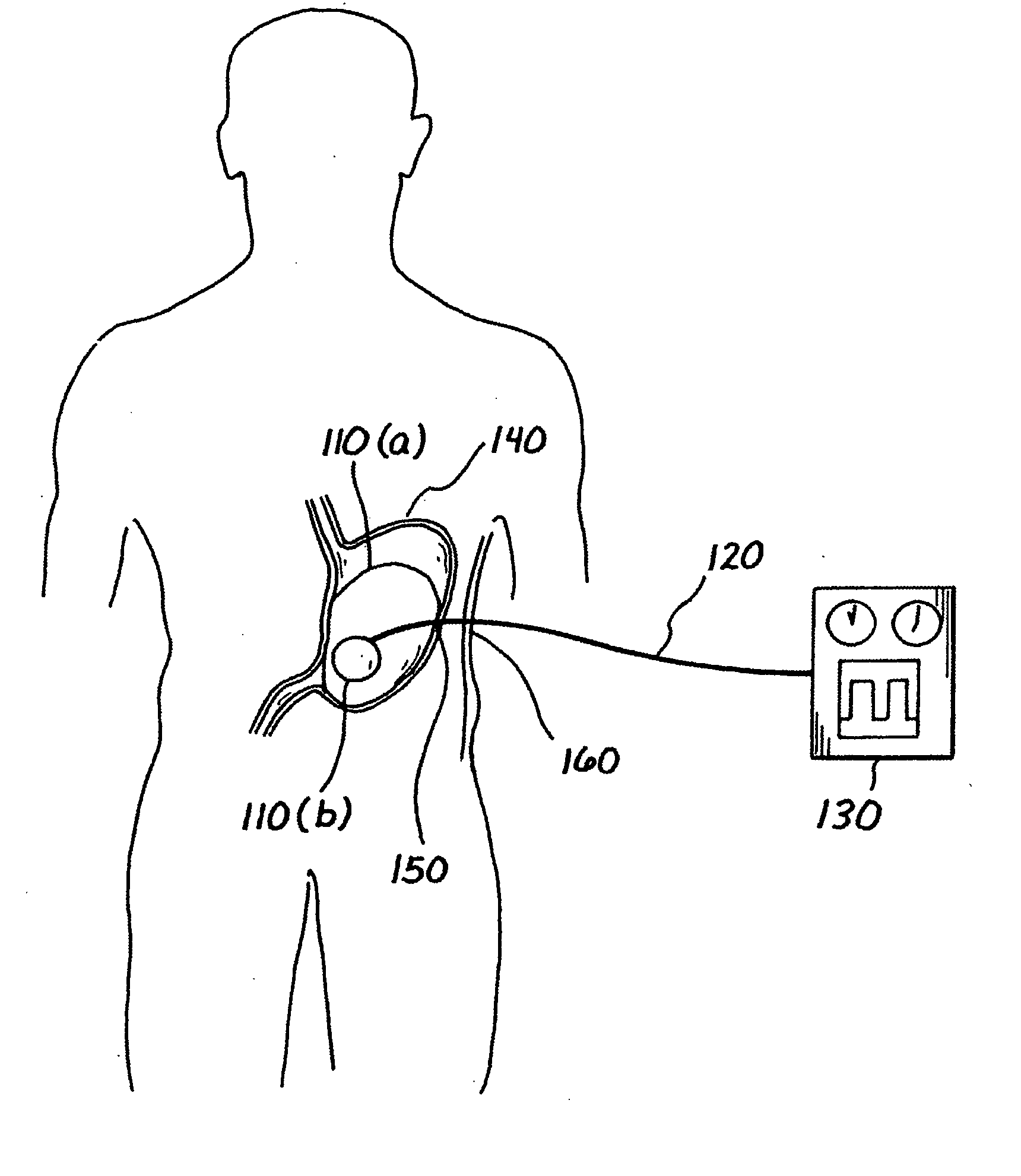Balloon system and methods for treating obesity