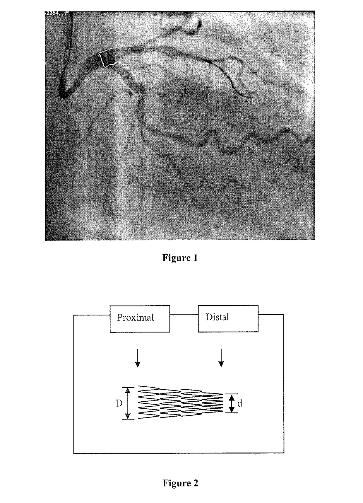 Method of producing personalized biomimetic drug-eluting coronary stents by 3D-printing