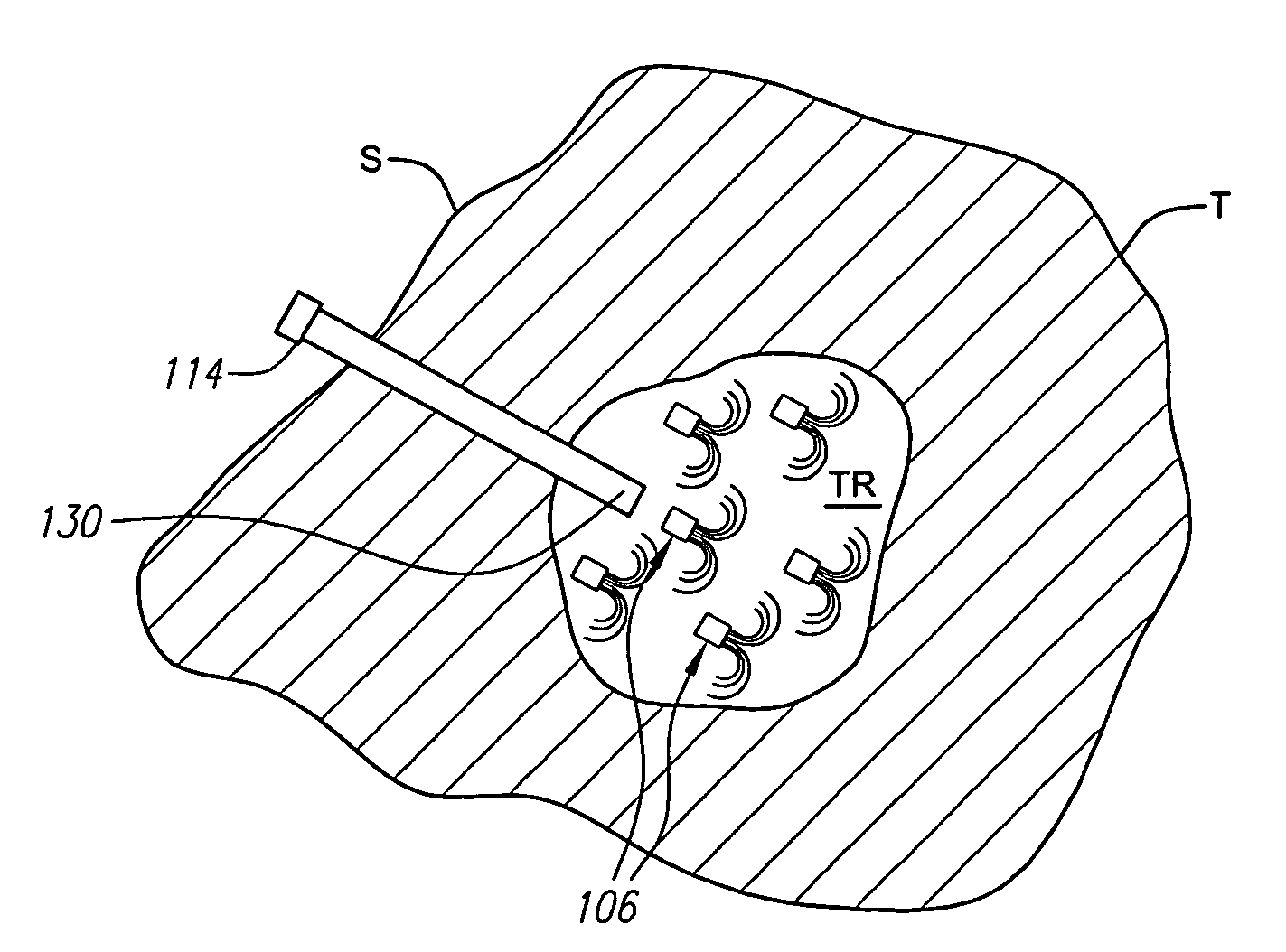 System for indirectly ablating tissue using implanted electrode devices