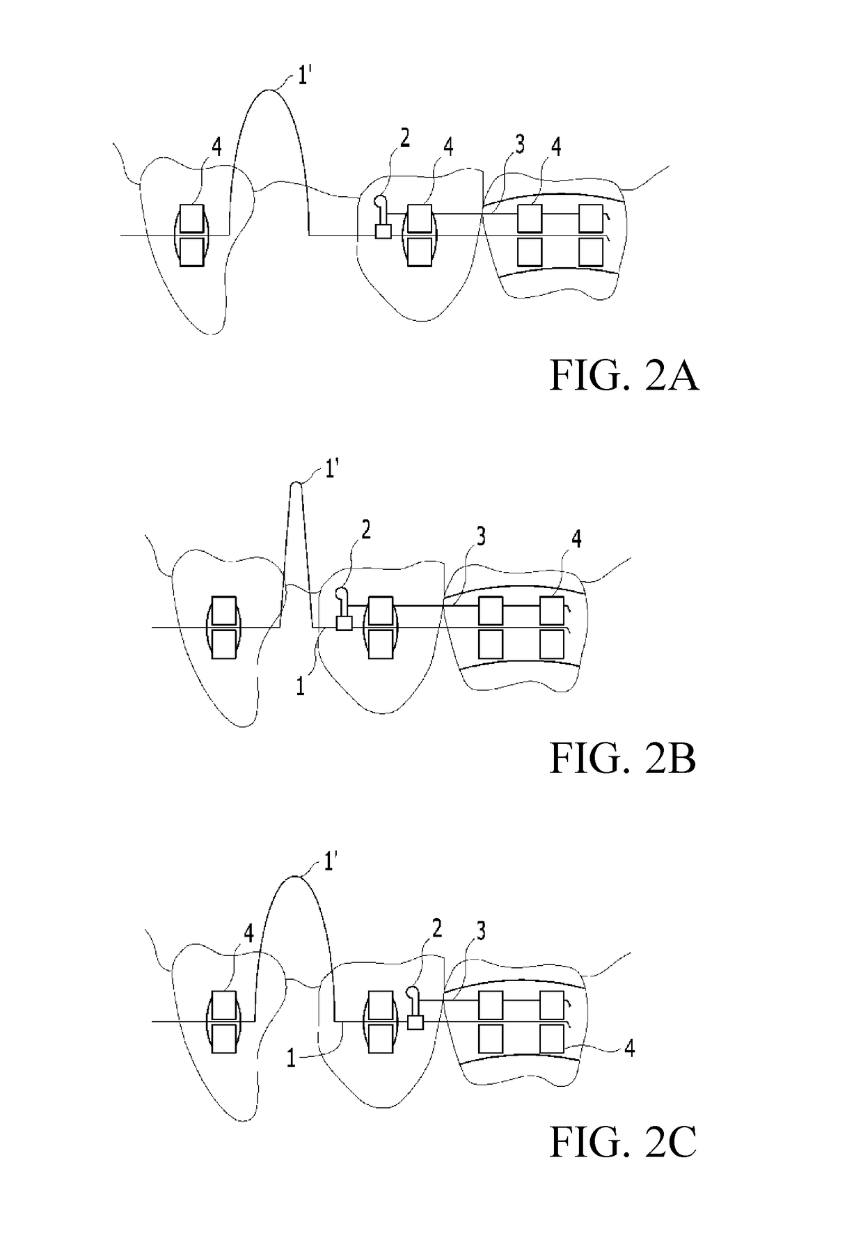 Variable cross-sectioned orthodontic archwire equipped with integrated hook