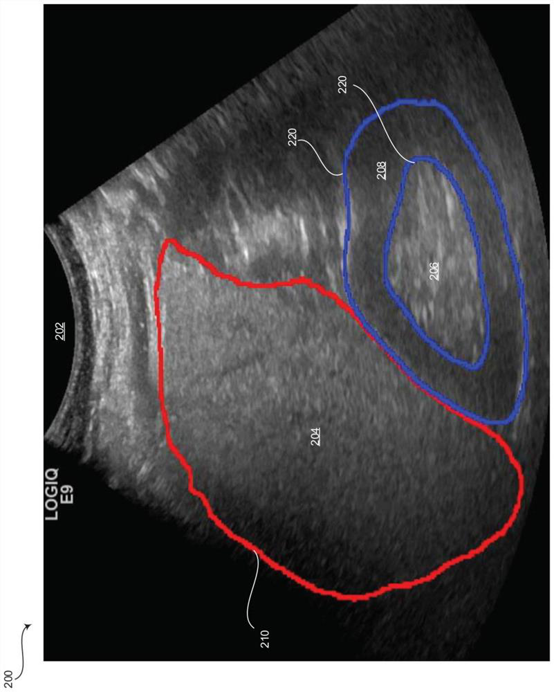 Method and system for automatically estimating hepatorenal index from ultrasound images