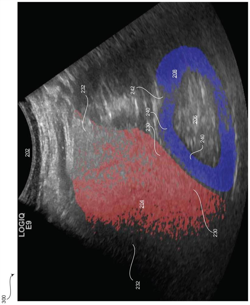 Method and system for automatically estimating hepatorenal index from ultrasound images