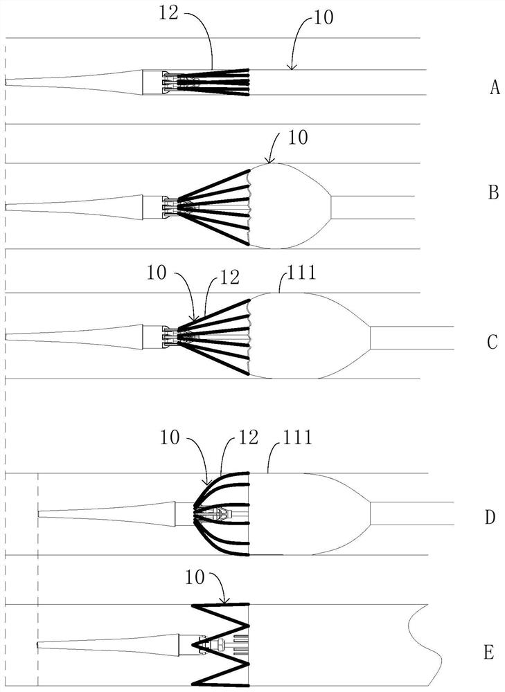 Stent Graft