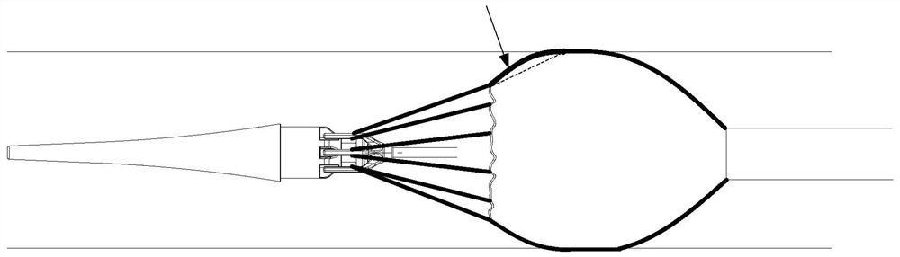 Stent Graft