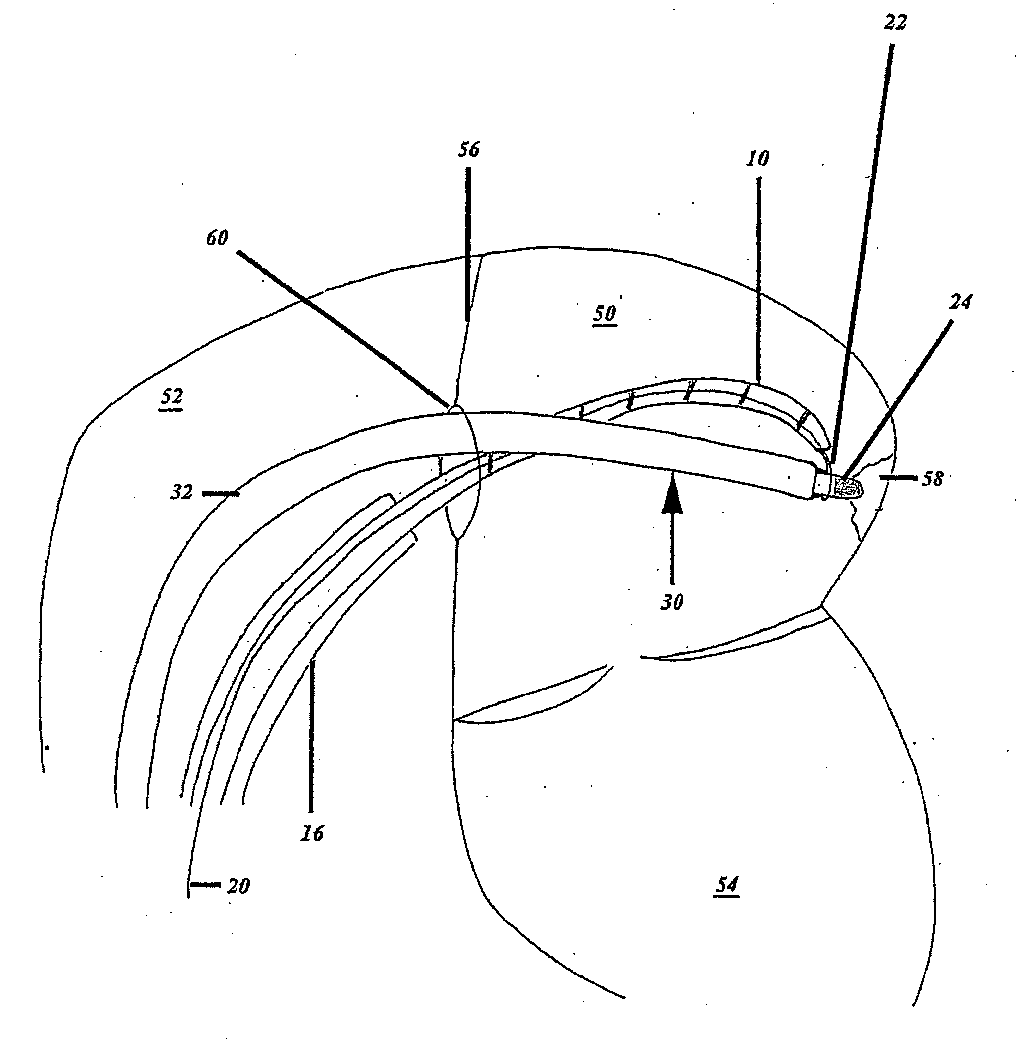 Catheter, Apparatus for Creating a Linear Ablation and a Method of Ablating Tissue