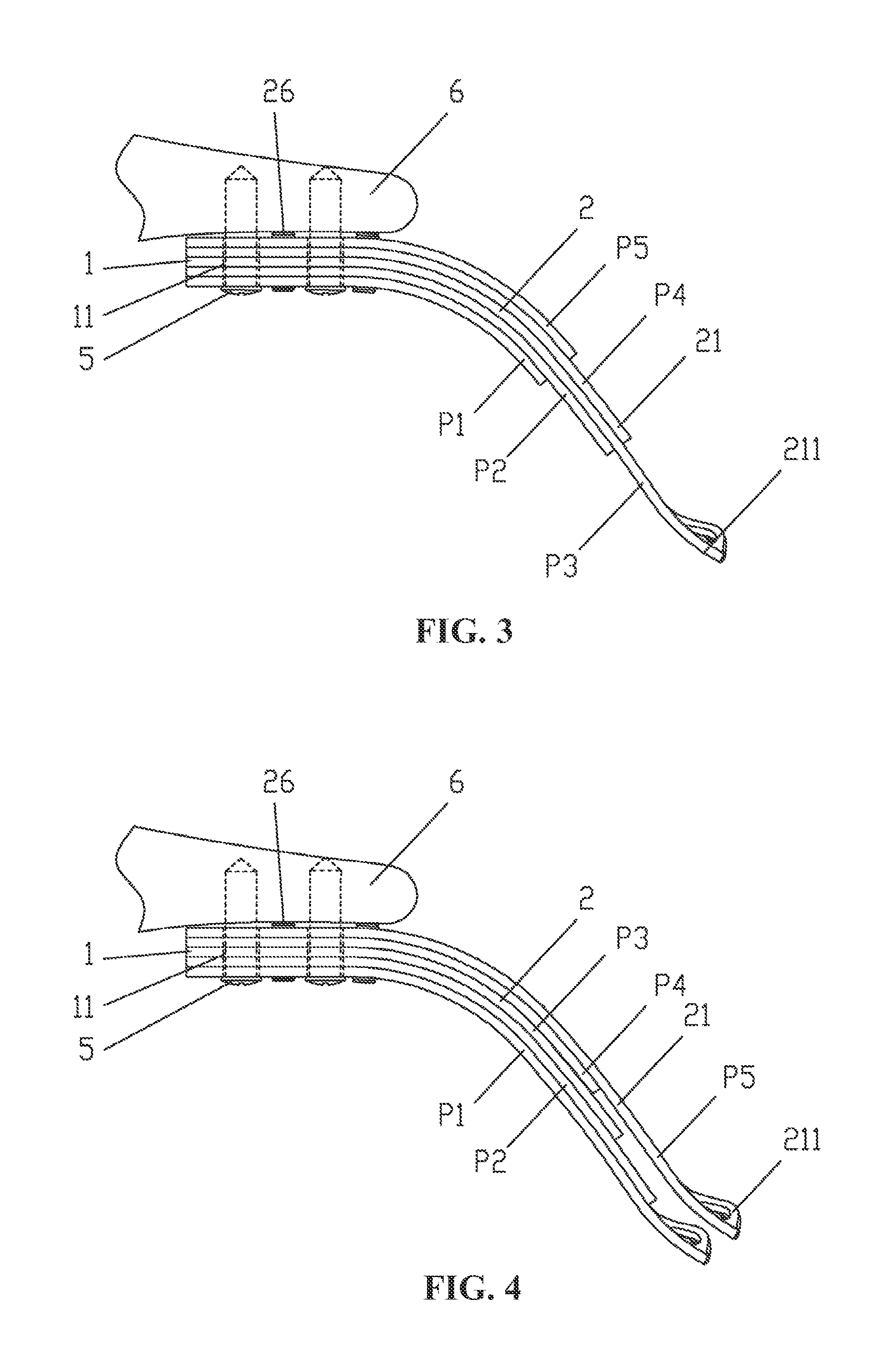 Layered soft palate support and implantation method