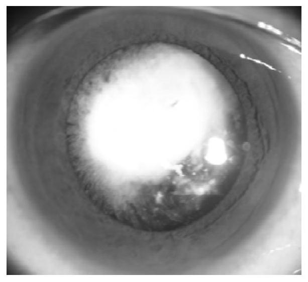 New gene mutation site causing congenital membranous cataract, detection method and application