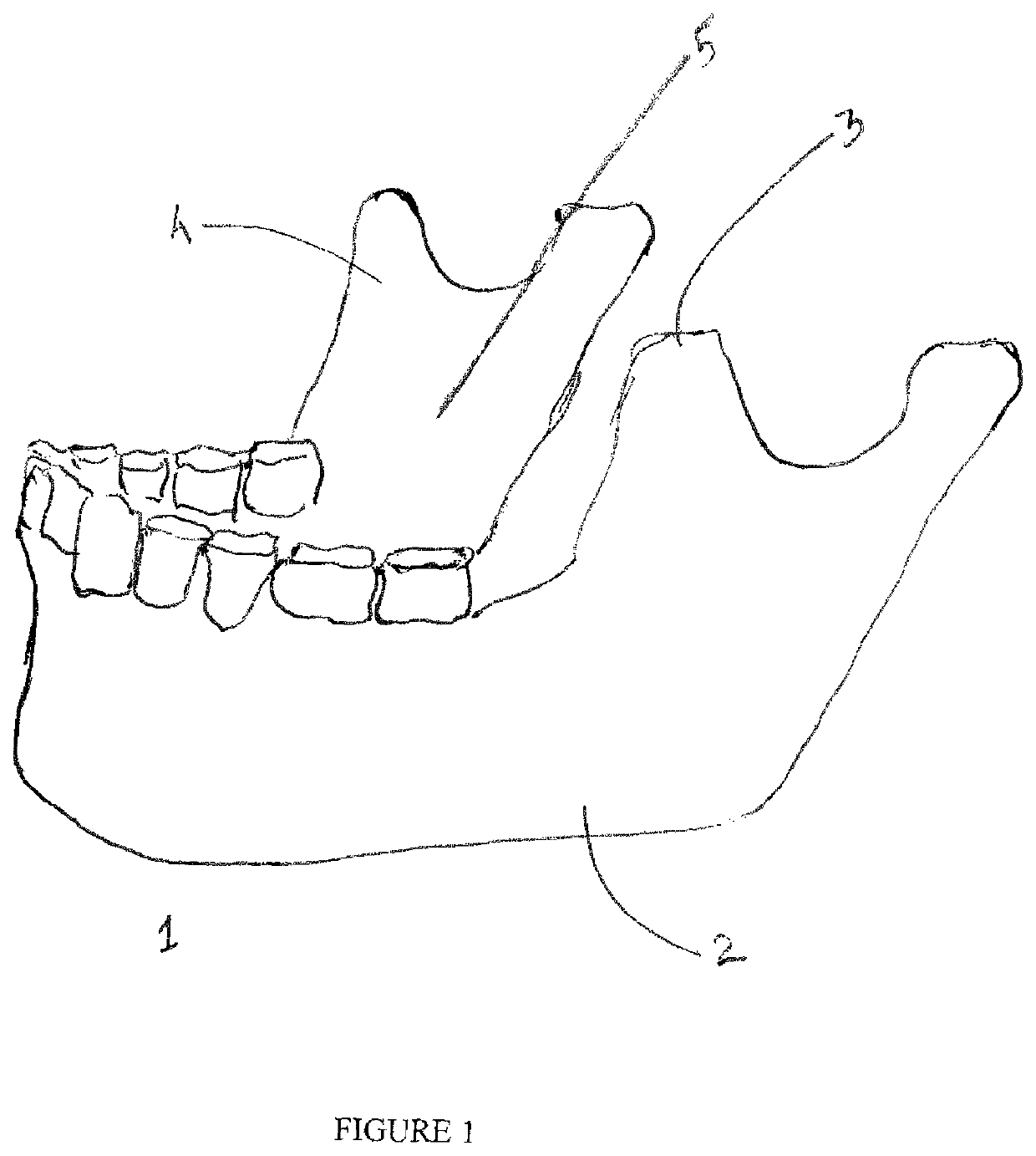 Guiding device for dental anesthesia