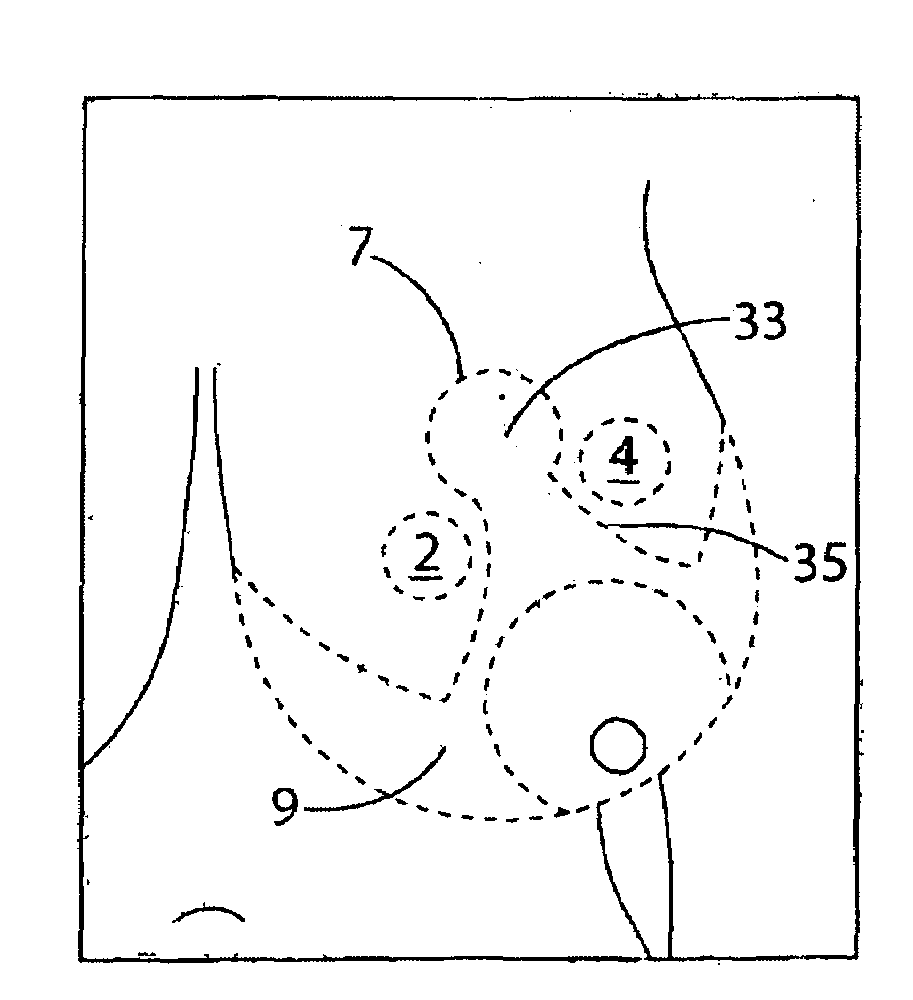 Marker Template for Breast Reduction Surgery