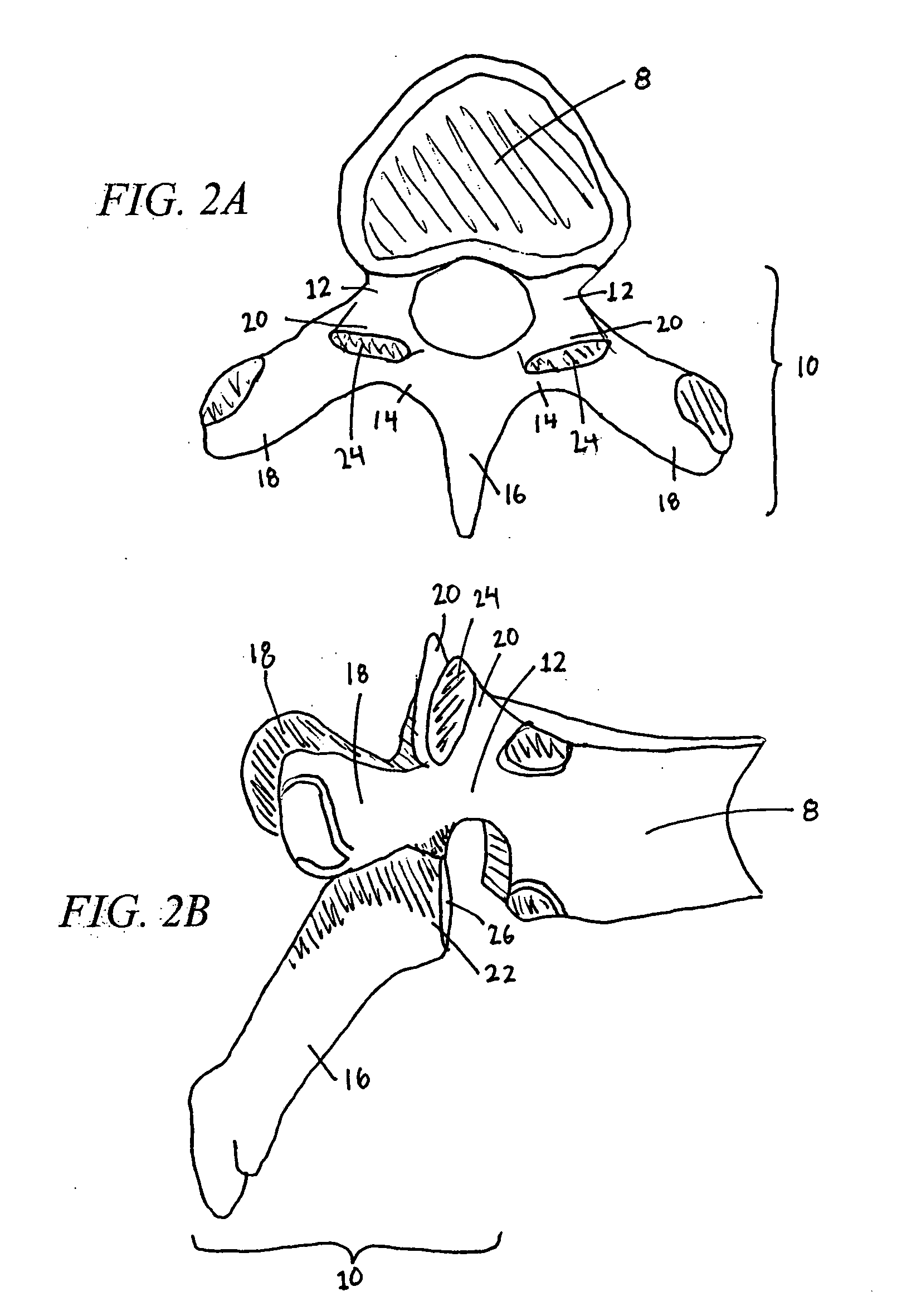 Vertebral facet joint prosthesis and method of fixation