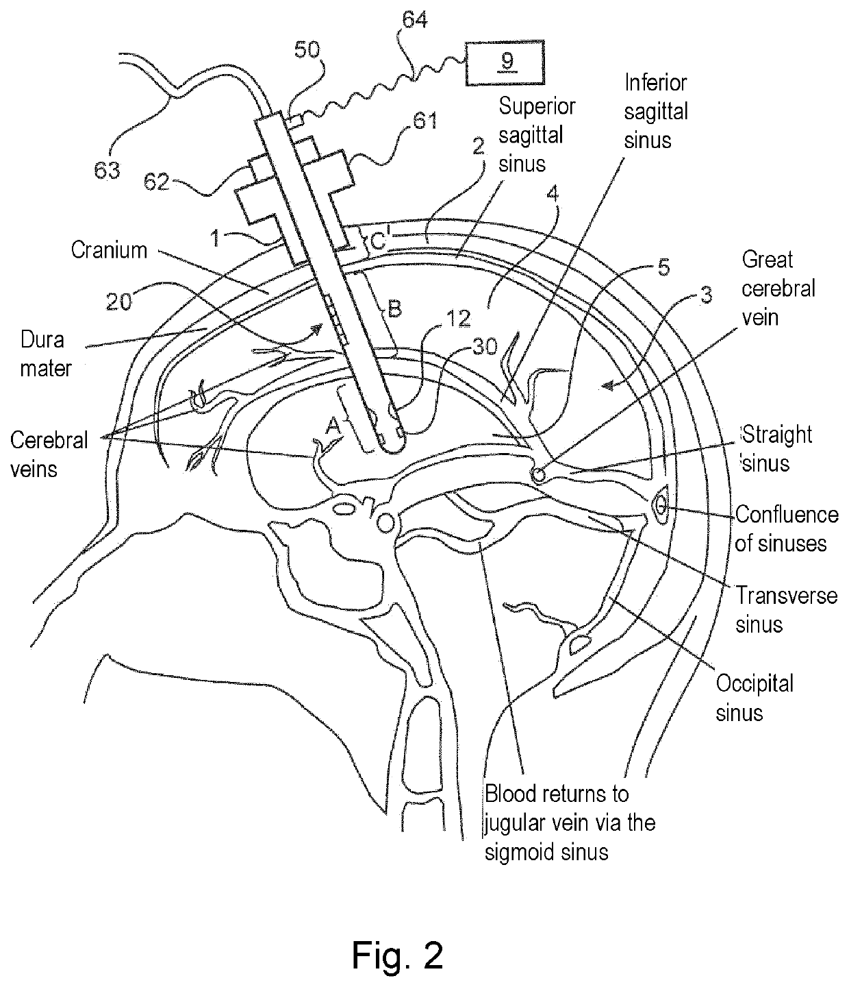 Device for drainage of the brain