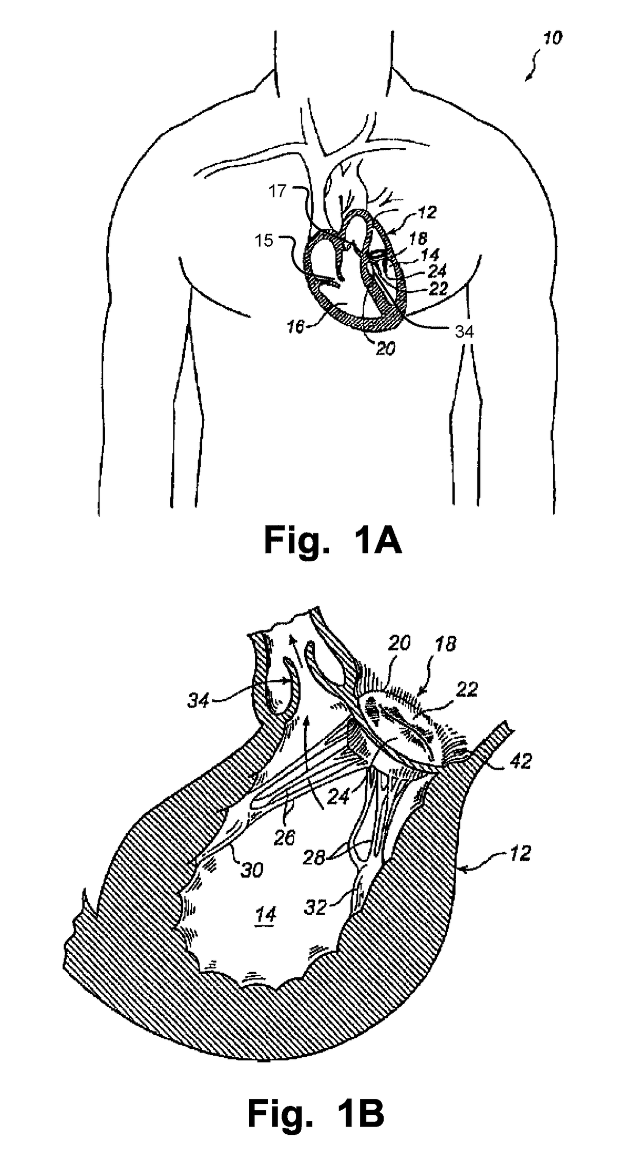 Medical system, a device for collecting chordae and/or leaflets and a method therefor
