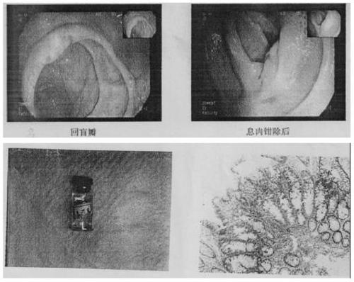 Traditional Chinese medicine composition and traditional Chinese medicine preparation for preventing relapse of postoperative intestinal polyp