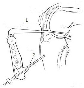 Fixing suspension device for posterior cruciate ligament avulsion fracture reduction surgery and operation method